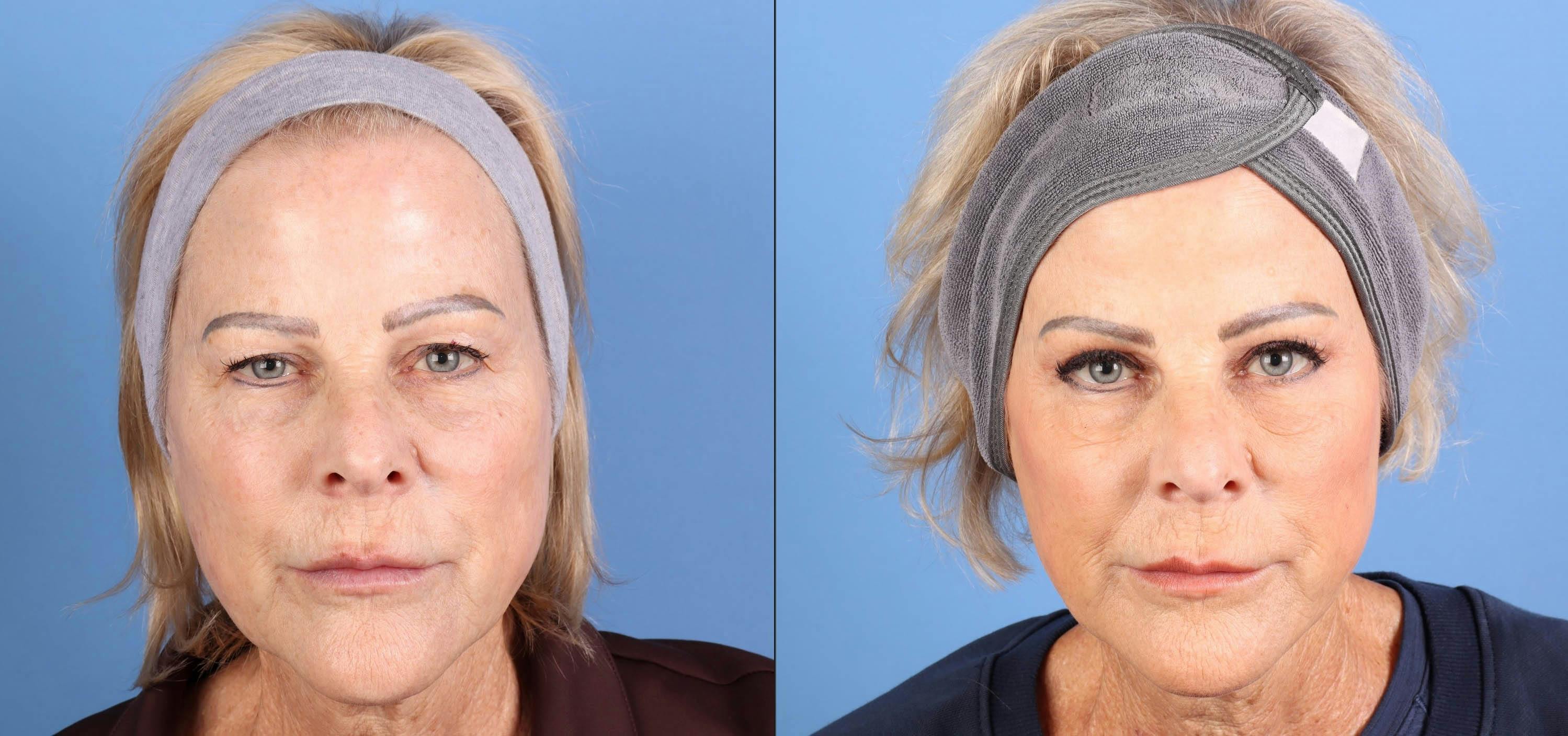 Eyelid Surgery (Upper Blepharoplasty) Before & After Gallery - Patient 344883 - Image 1