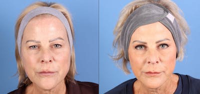 Eyelid Surgery (Upper Blepharoplasty) Before & After Gallery - Patient 235853 - Image 1