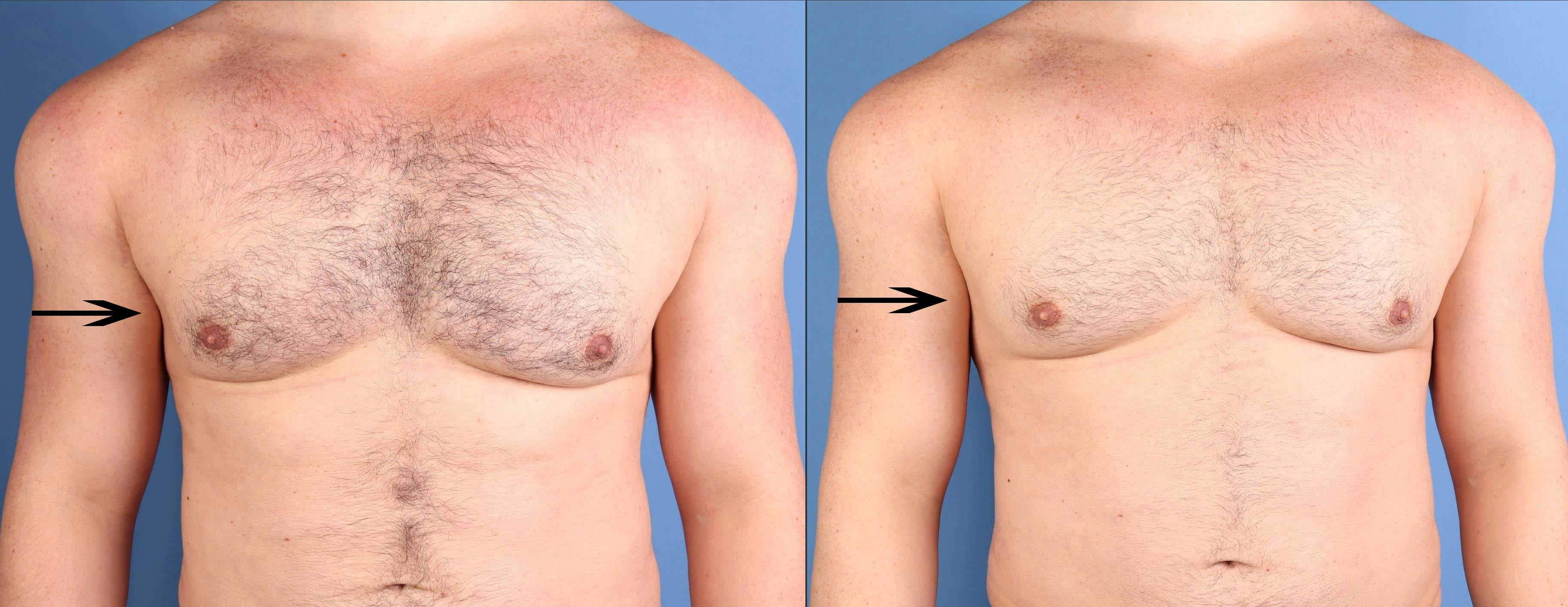 AlloClae Before & After Gallery - Patient 143425 - Image 1