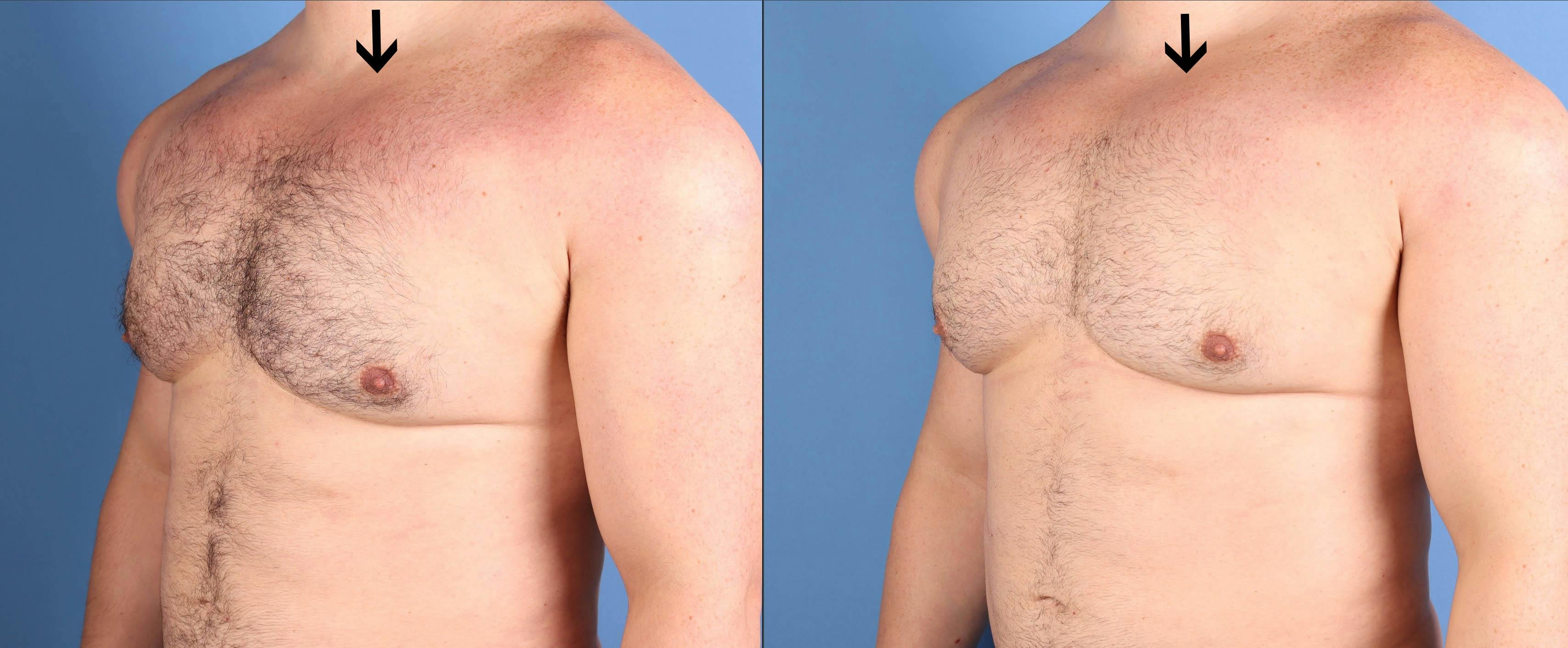 AlloClae Before & After Gallery - Patient 143425 - Image 2