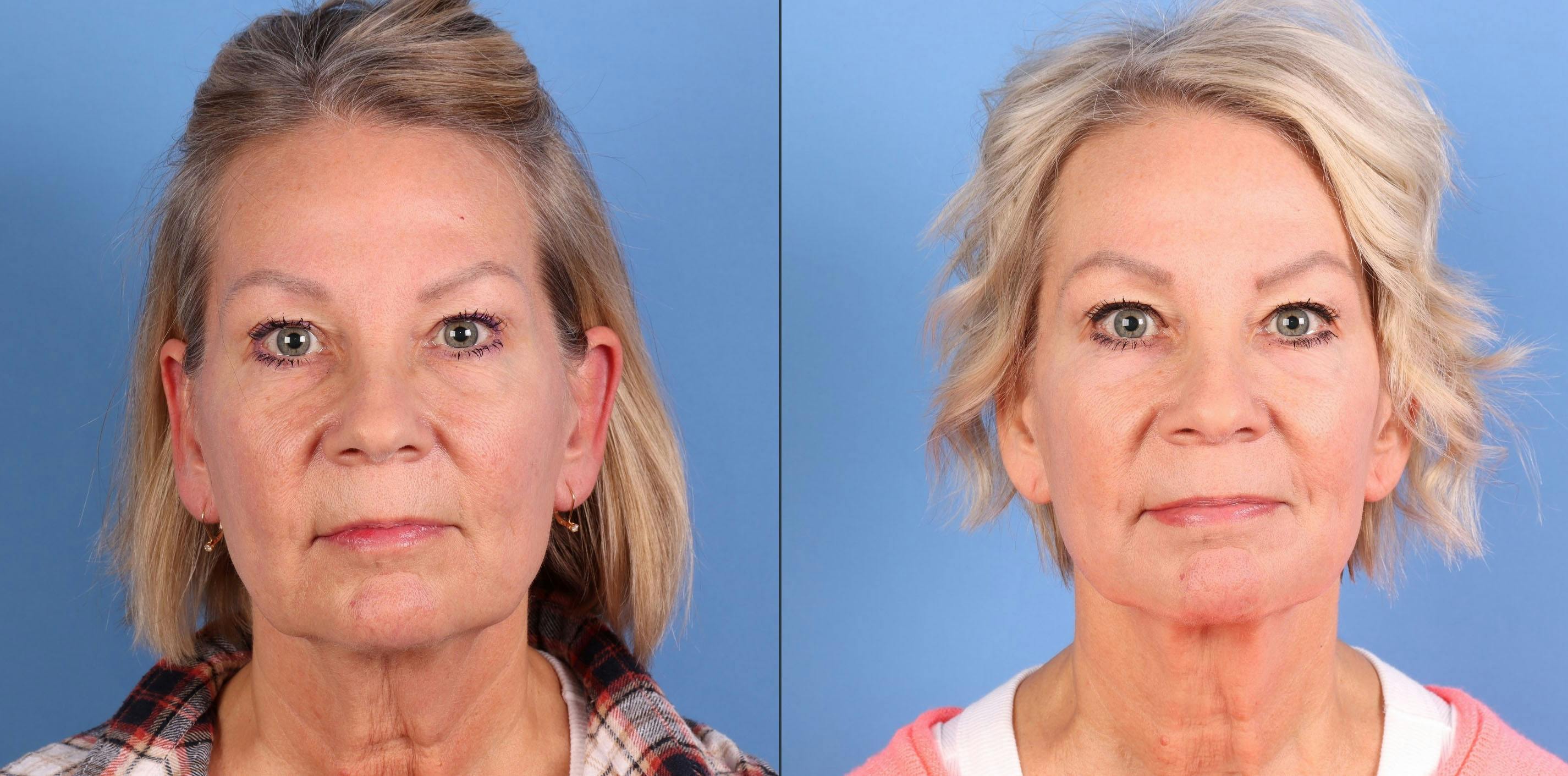 Mini Facelift Before & After Gallery - Patient 262991 - Image 1