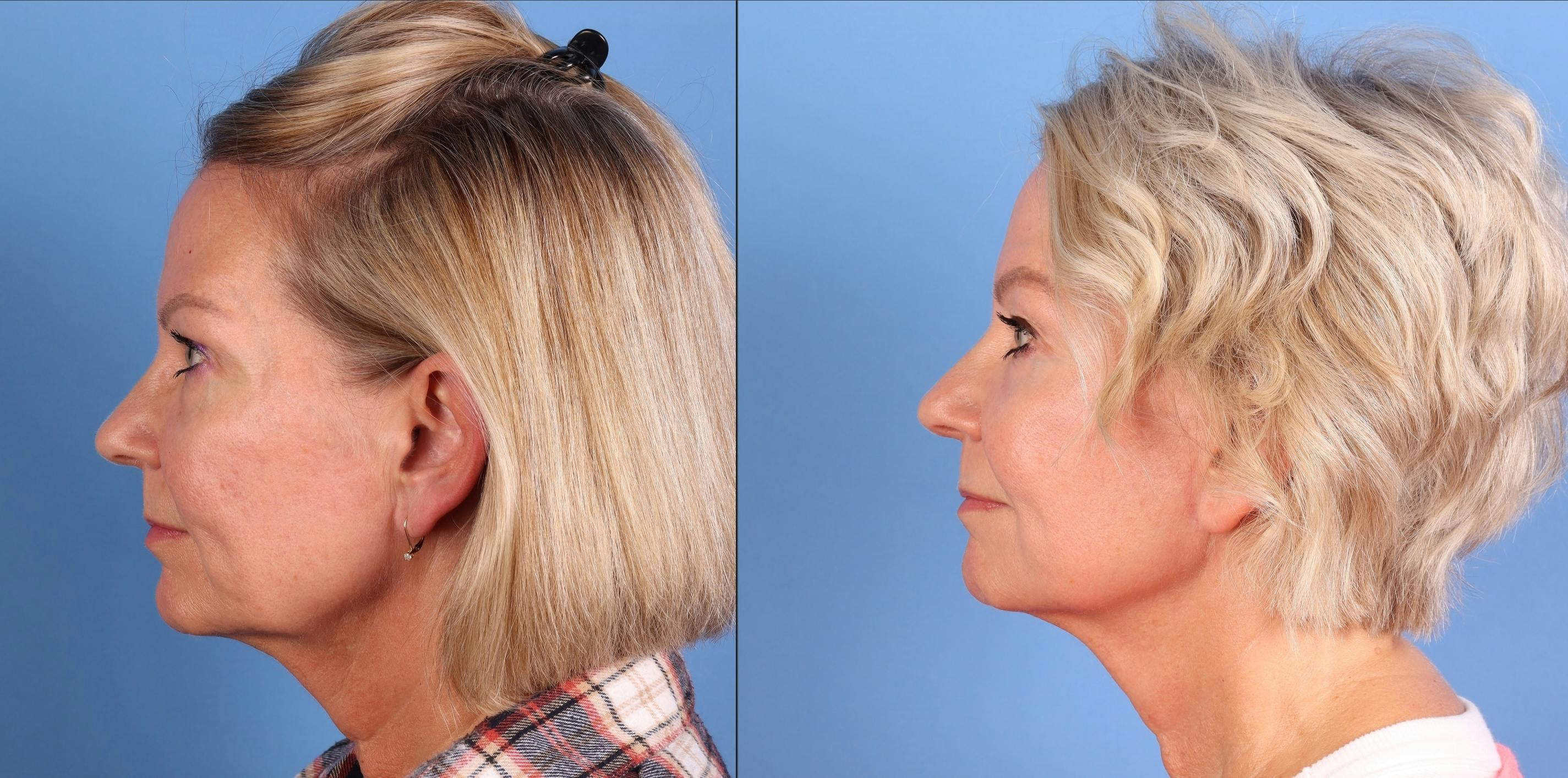 Mini Facelift Before & After Gallery - Patient 262991 - Image 3