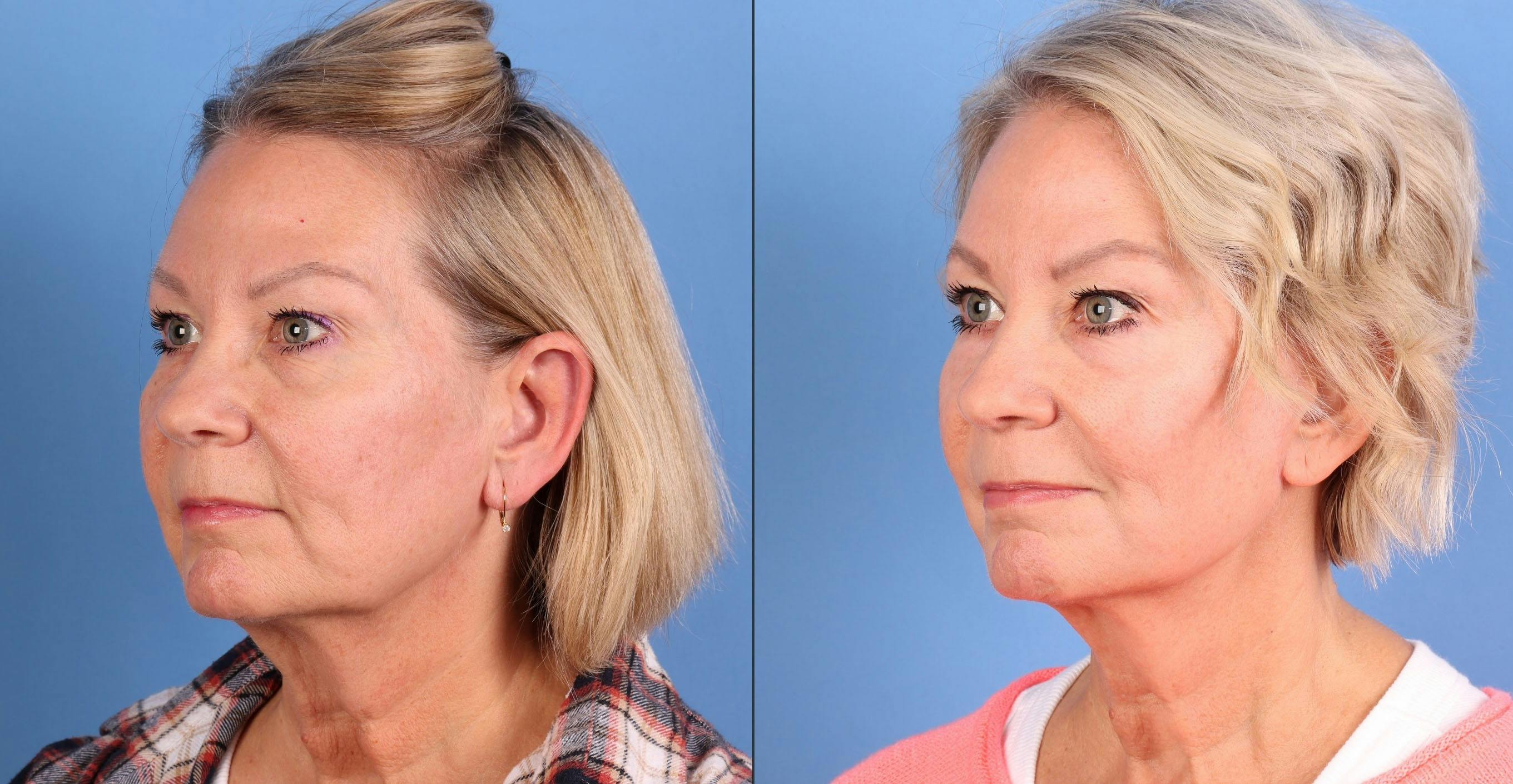 Mini Facelift Before & After Gallery - Patient 262991 - Image 2