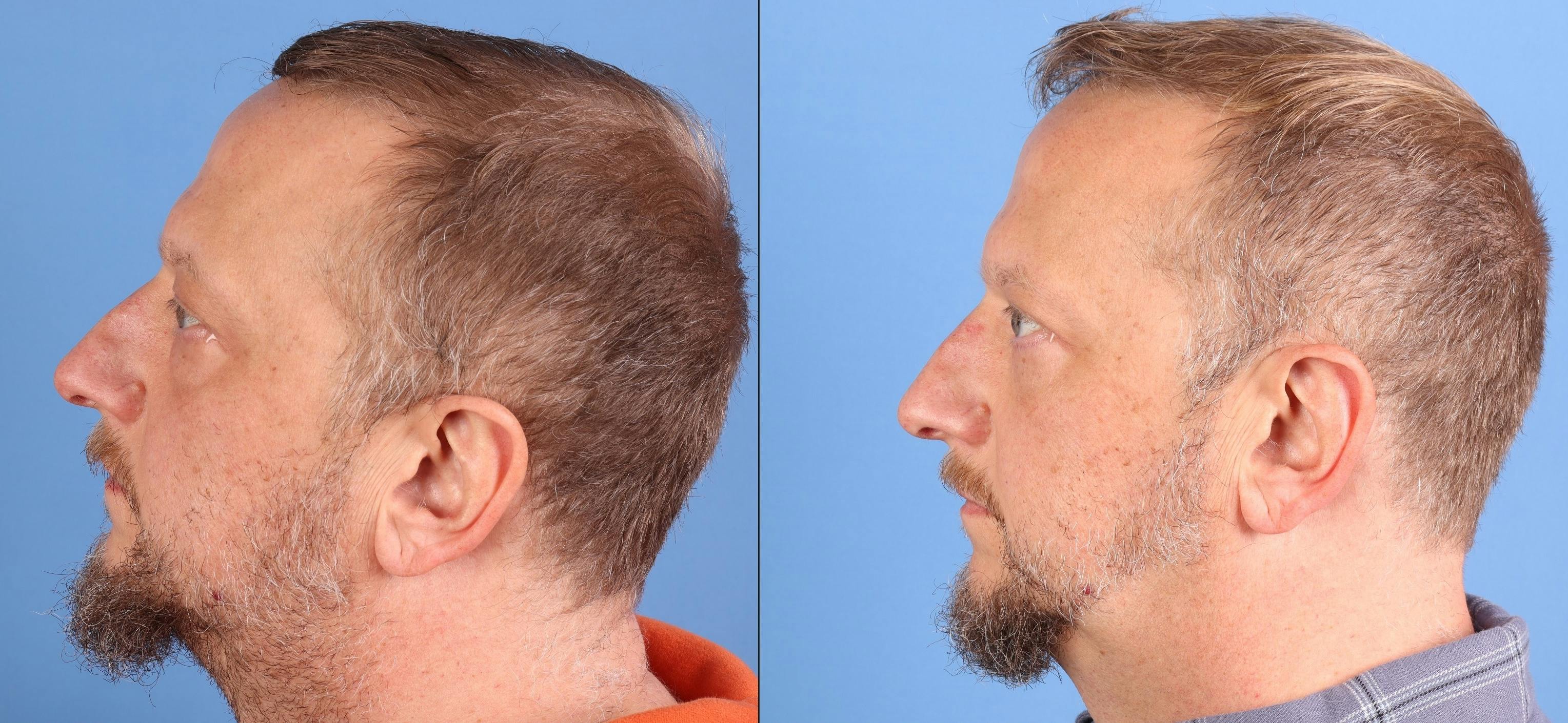 Eyelid Surgery (Upper & Lower Blepharoplasty) Before & After Gallery - Patient 468641 - Image 3