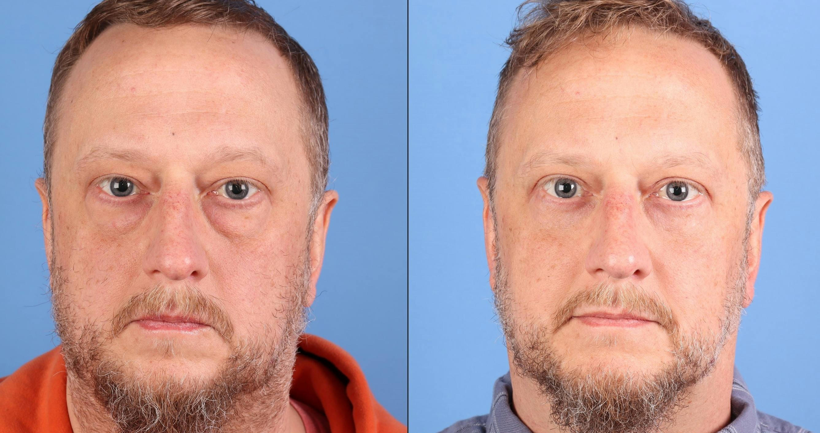 Eyelid Surgery (Upper & Lower Blepharoplasty) Before & After Gallery - Patient 468641 - Image 1