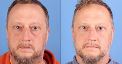 Eyelid Surgery (Upper & Lower Blepharoplasty) Before & After Gallery - Patient 468641 - Image 1