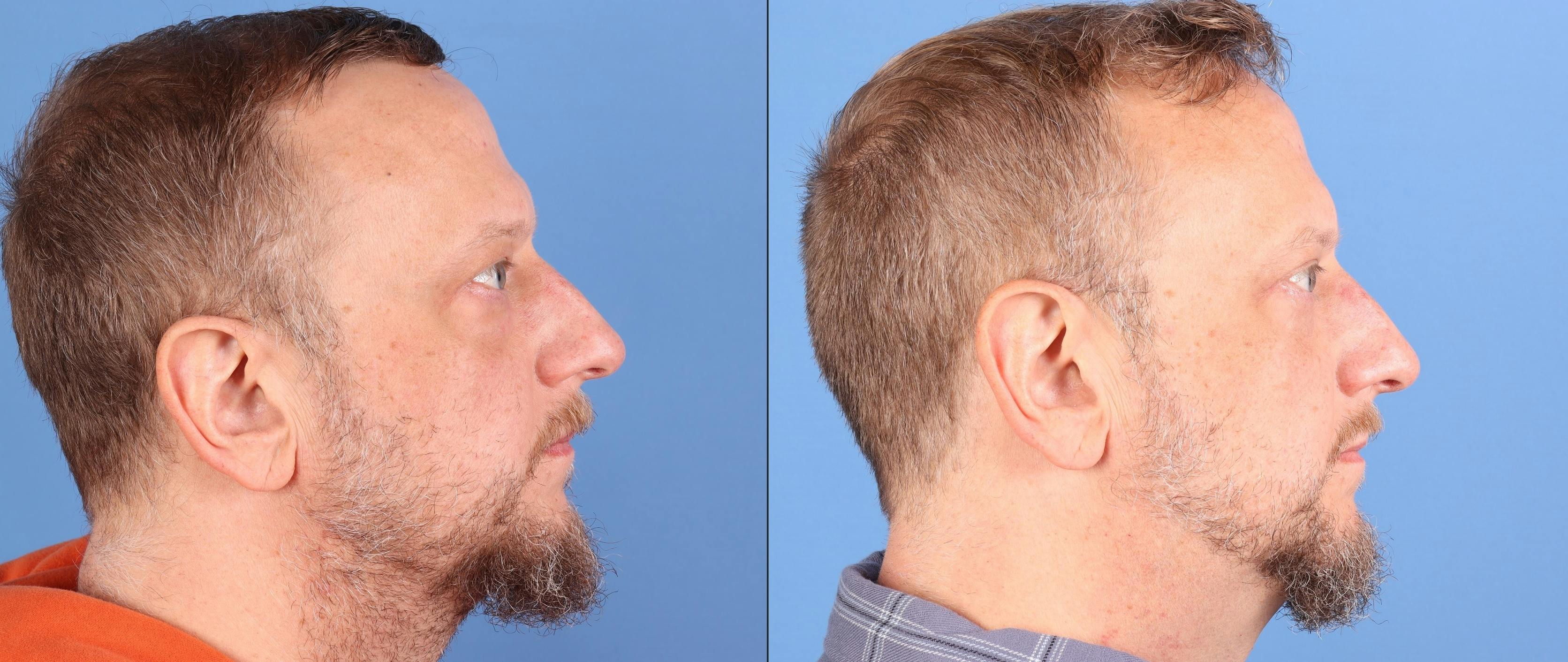 Eyelid Surgery (Upper & Lower Blepharoplasty) Before & After Gallery - Patient 468641 - Image 5