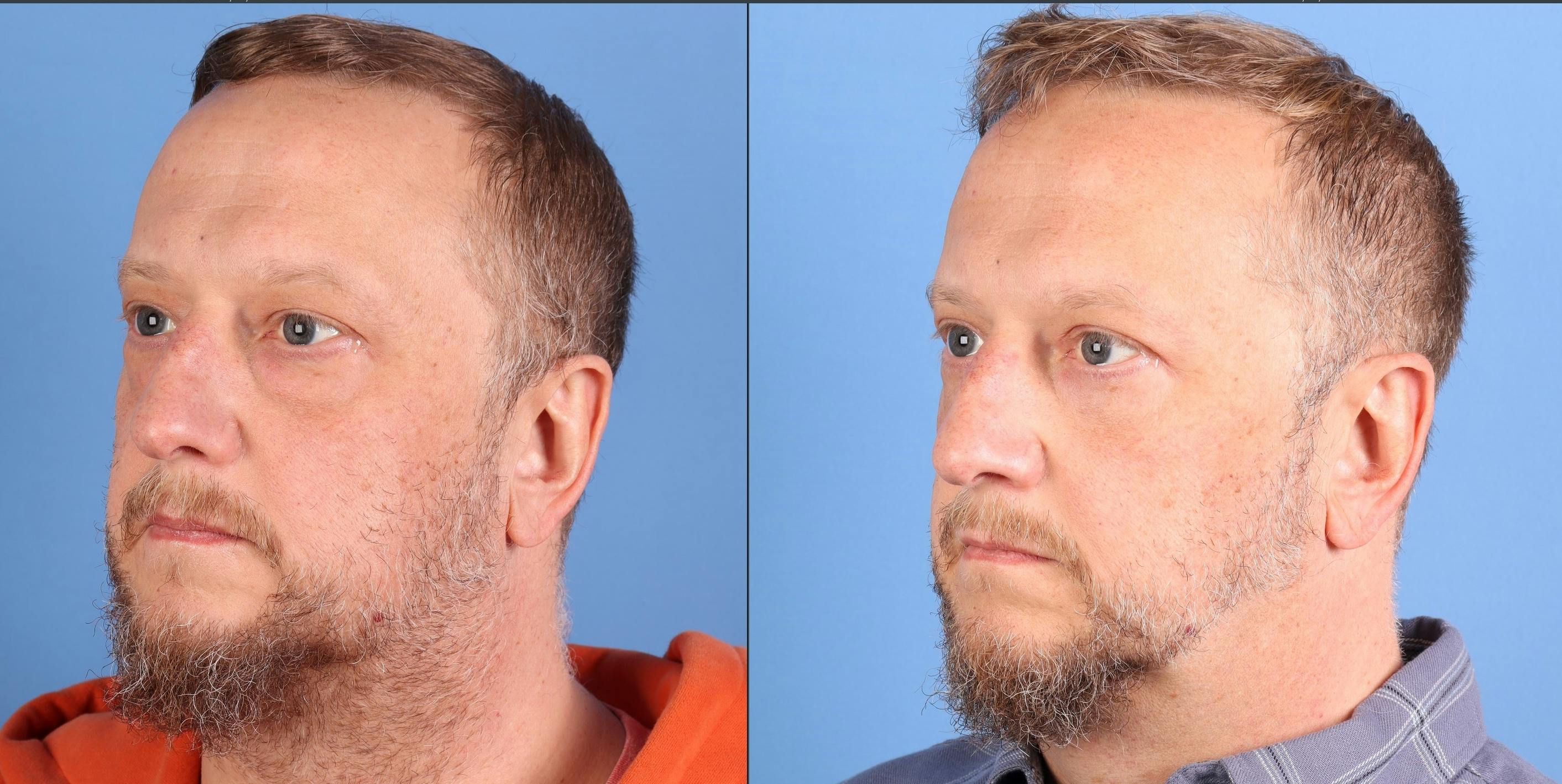 Eyelid Surgery (Upper & Lower Blepharoplasty) Before & After Gallery - Patient 468641 - Image 2