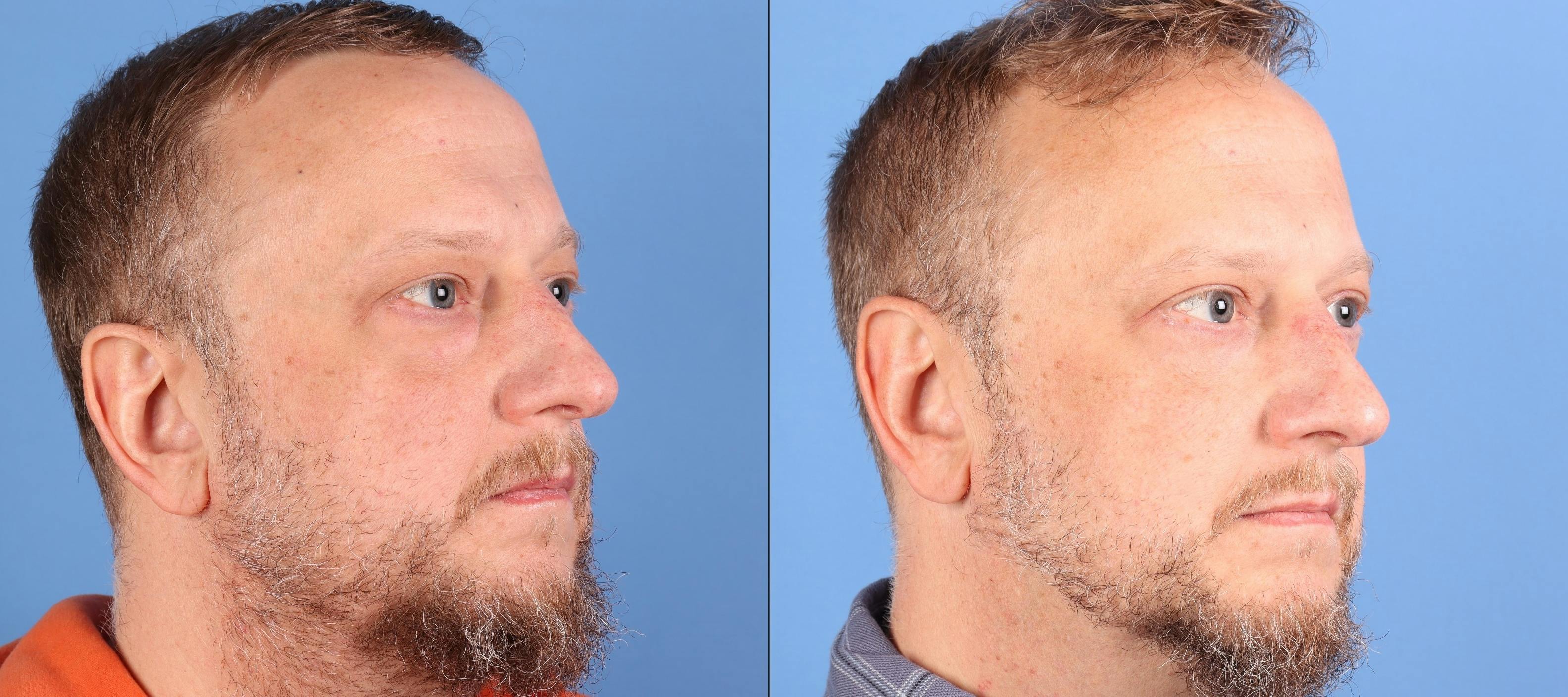 Eyelid Surgery (Upper & Lower Blepharoplasty) Before & After Gallery - Patient 468641 - Image 4