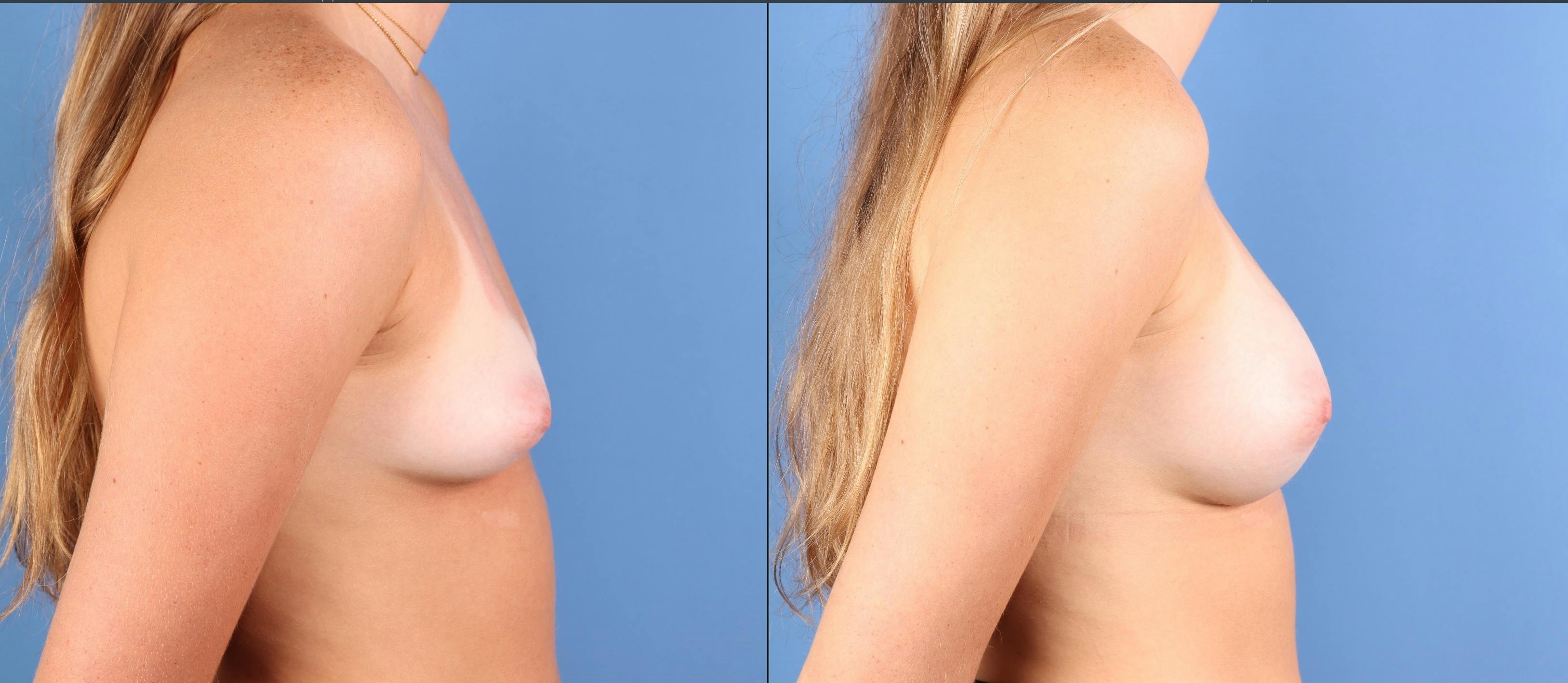 Breast Augmentation Before & After Gallery - Patient 416603 - Image 5