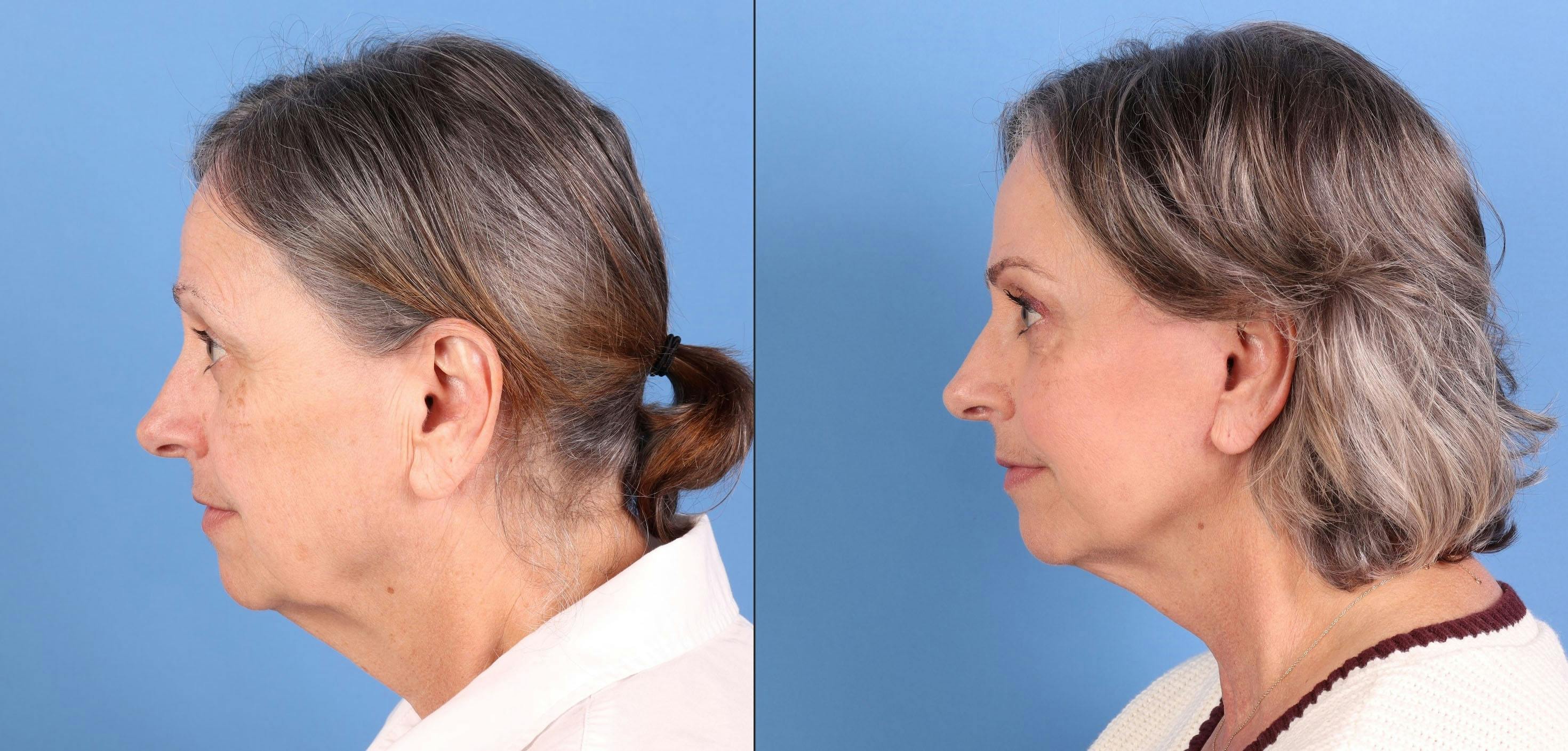 Mini Facelift Before & After Gallery - Patient 359637 - Image 5