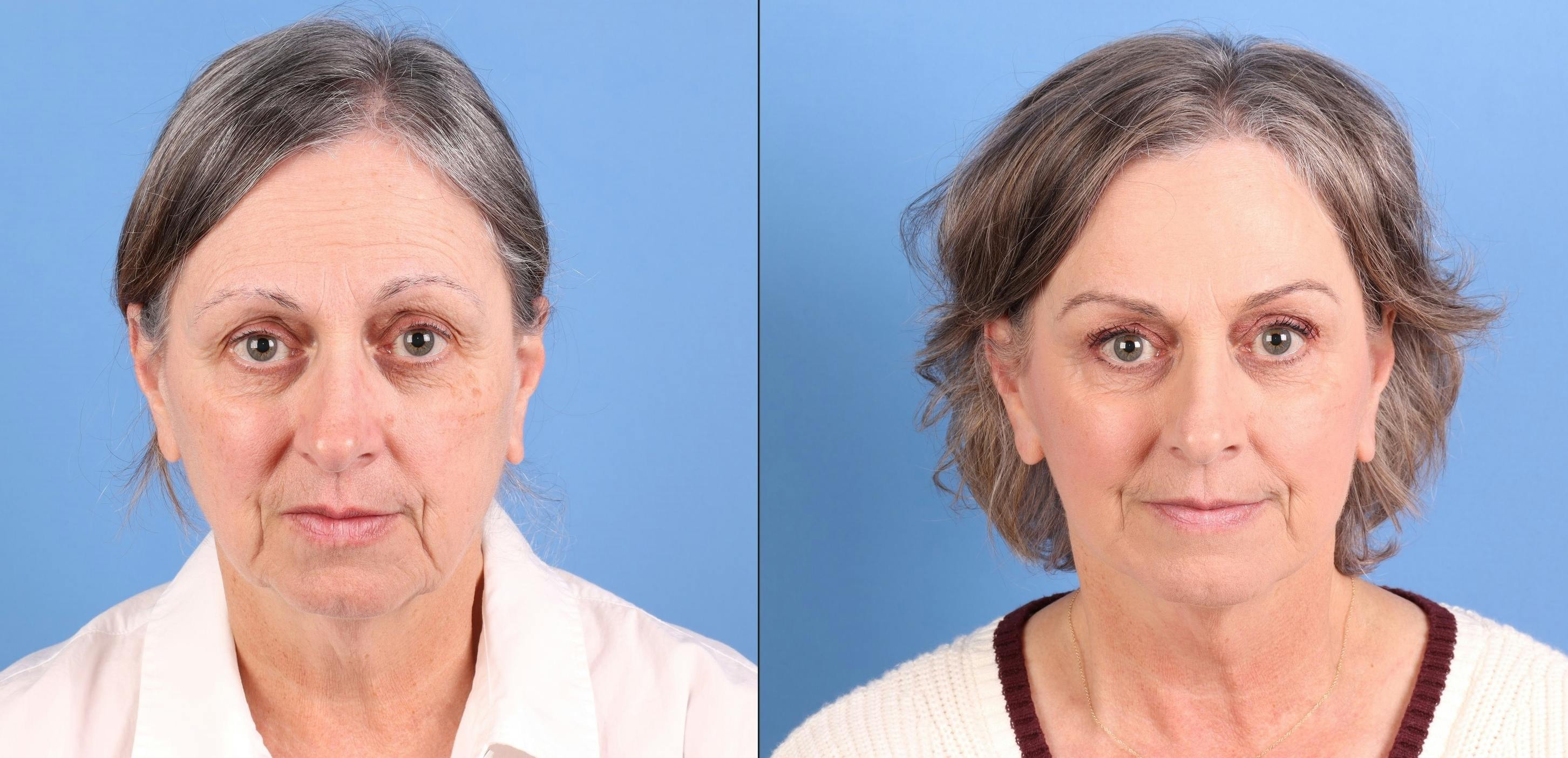 Mini Facelift Before & After Gallery - Patient 359637 - Image 1