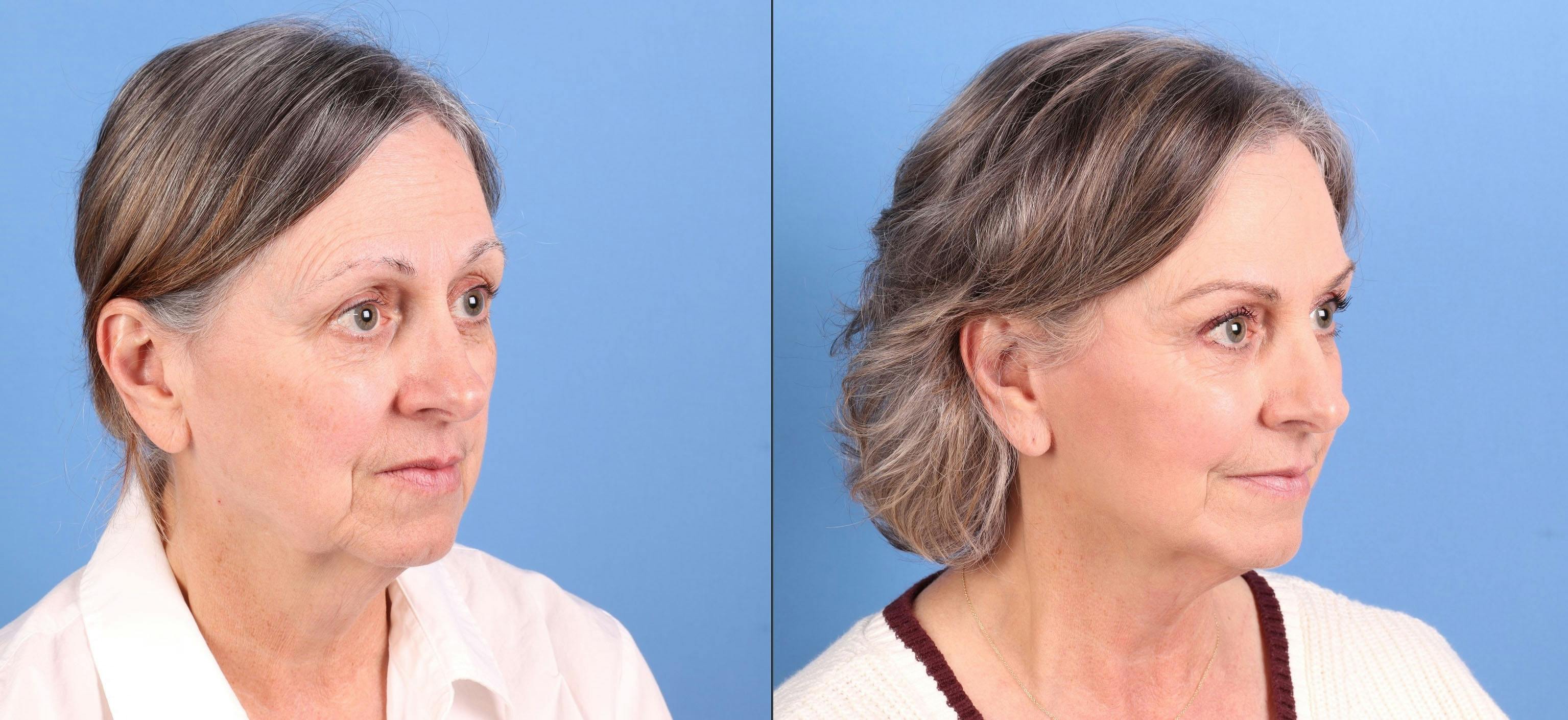 Mini Facelift Before & After Gallery - Patient 359637 - Image 2