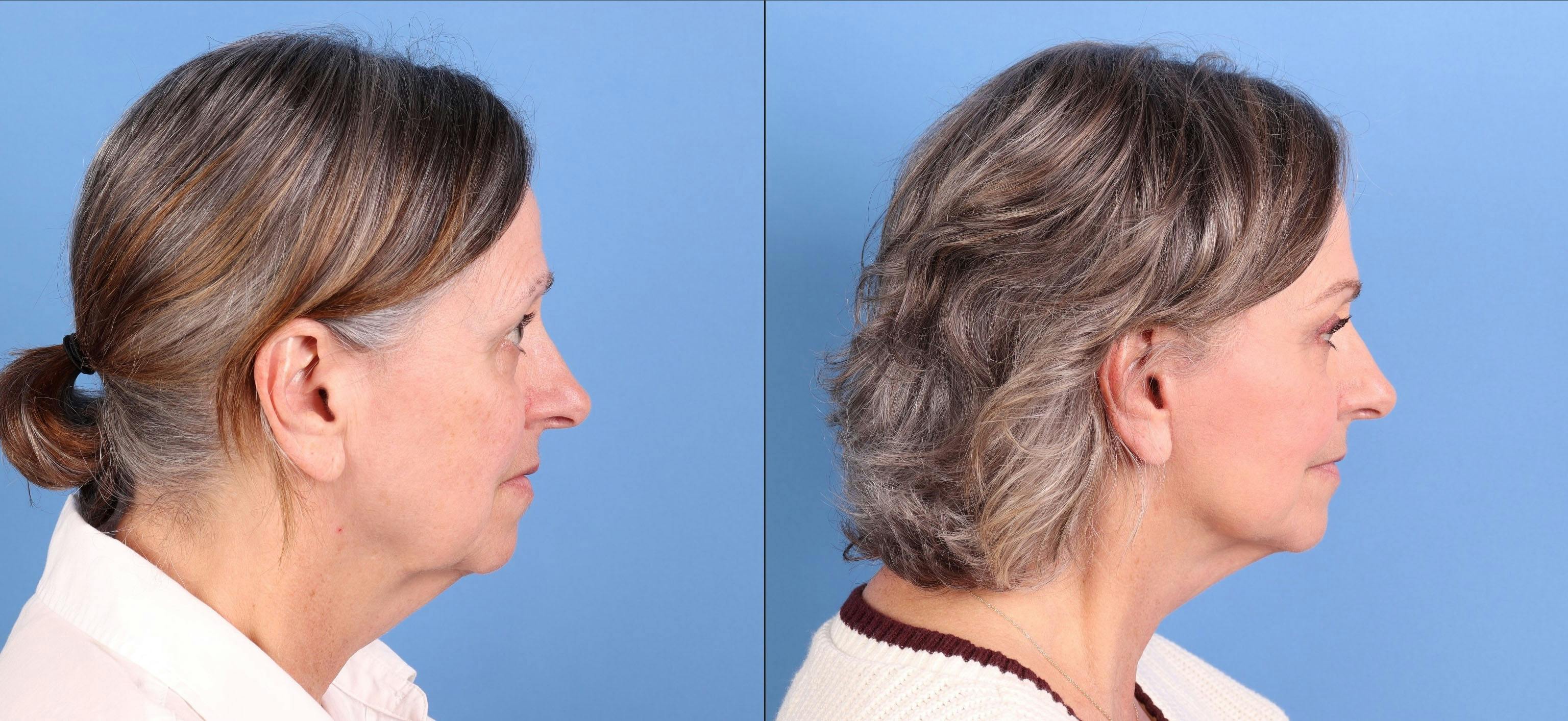 Mini Facelift Before & After Gallery - Patient 359637 - Image 3