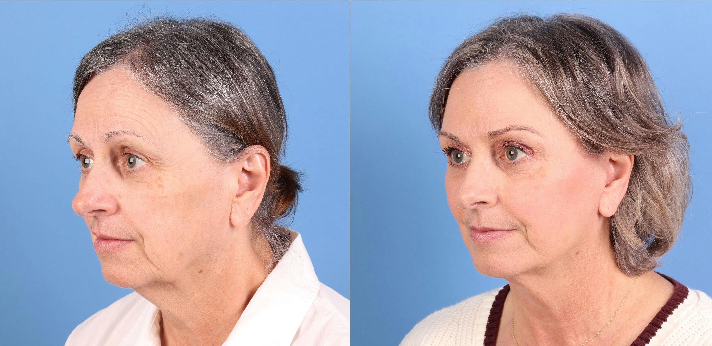 Mini Facelift Before & After Gallery - Patient 359637 - Image 4