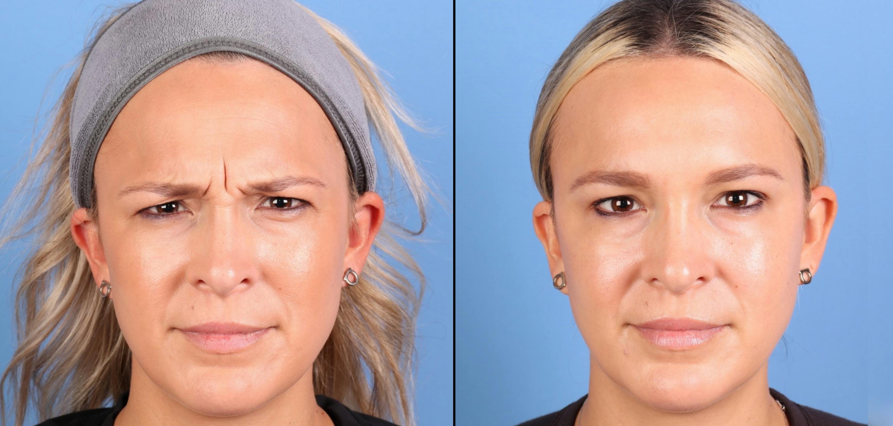 Botox Before & After Gallery - Patient 848840 - Image 1