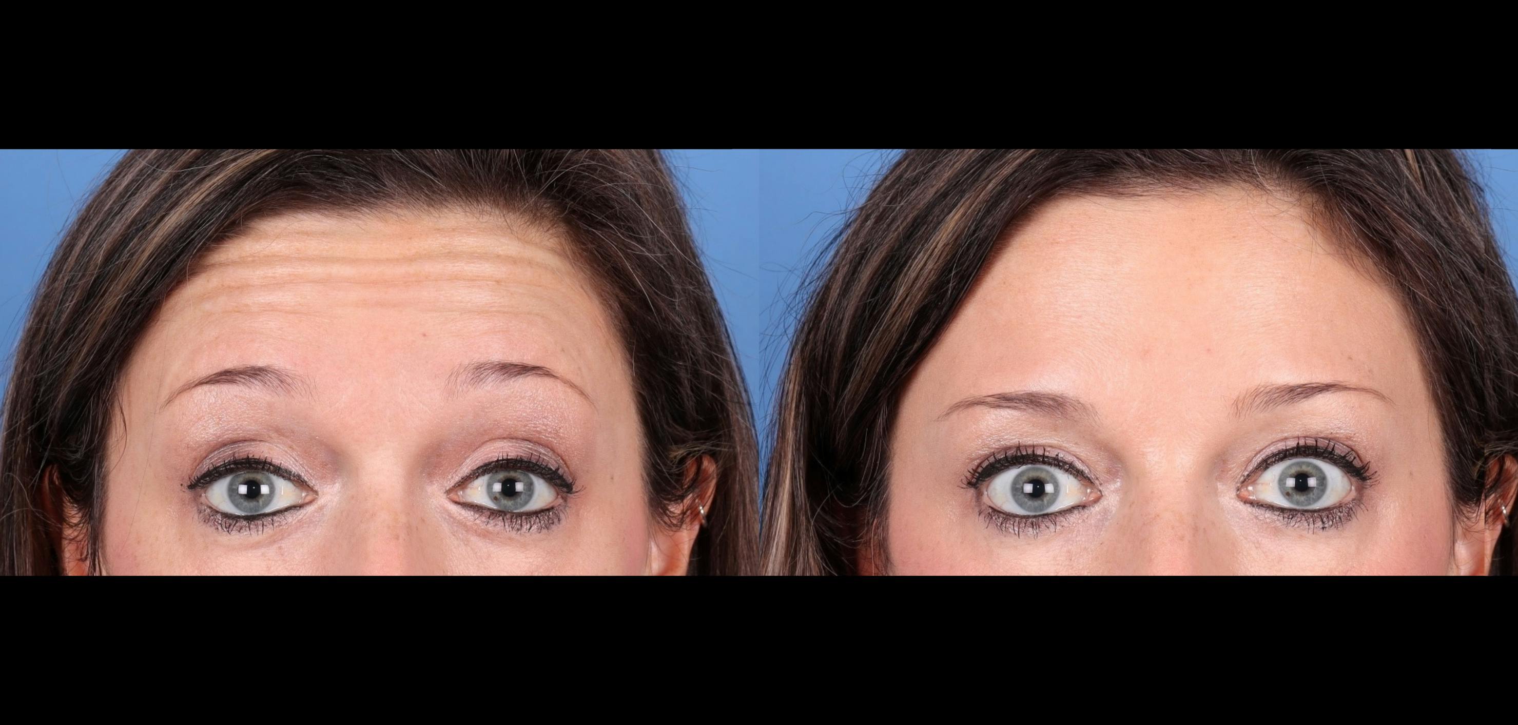Botox Before & After Gallery - Patient 391853 - Image 1
