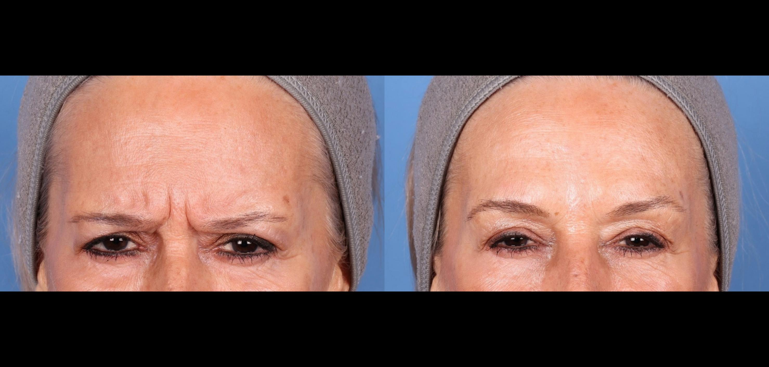 Botox Before & After Gallery - Patient 411123 - Image 1