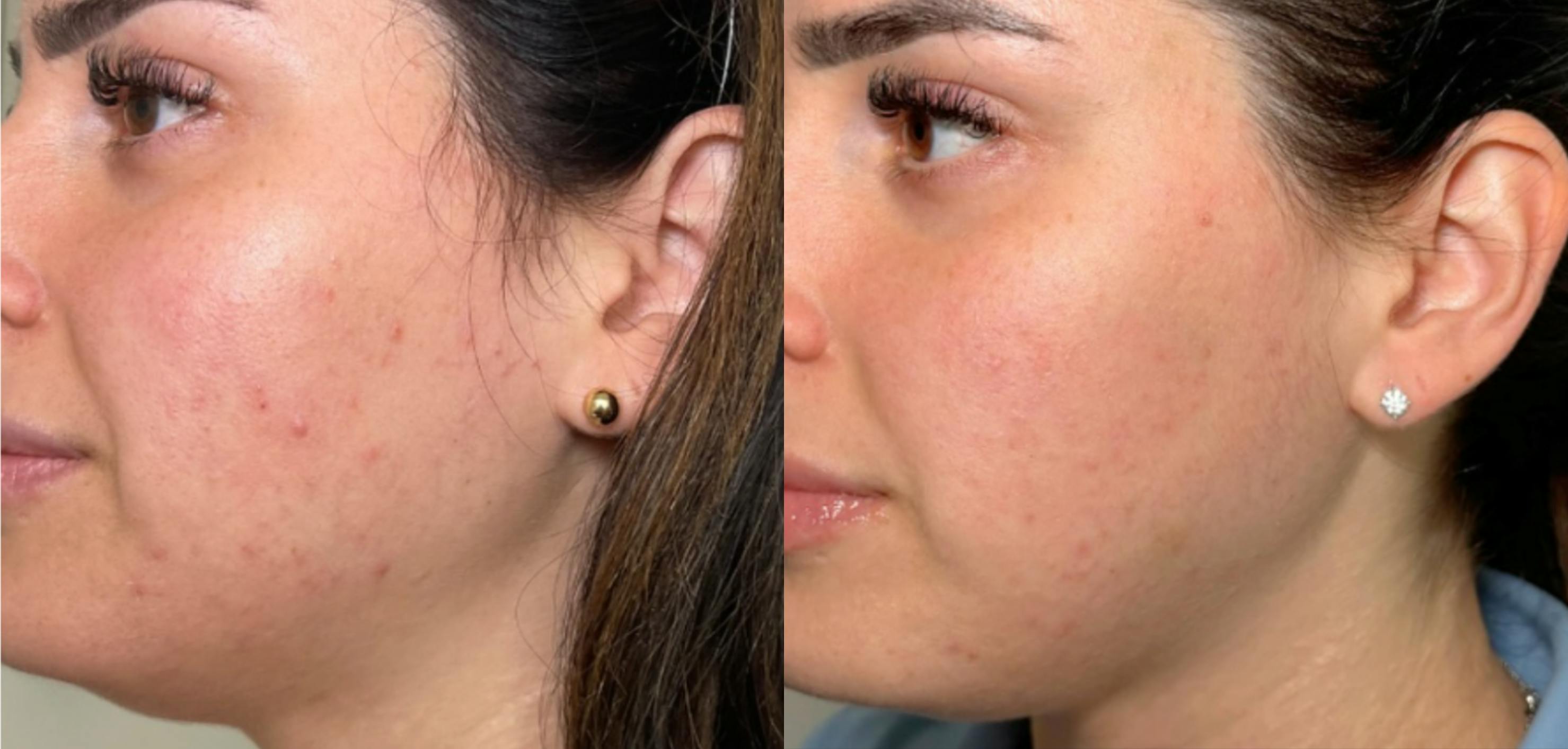 Acne Scar Treatment Before & After Gallery - Patient 216298 - Image 1