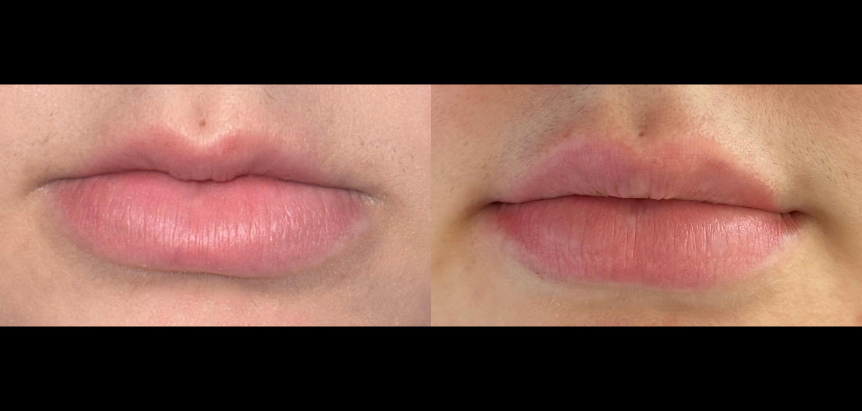 Botox Before & After Gallery - Patient 416884 - Image 1