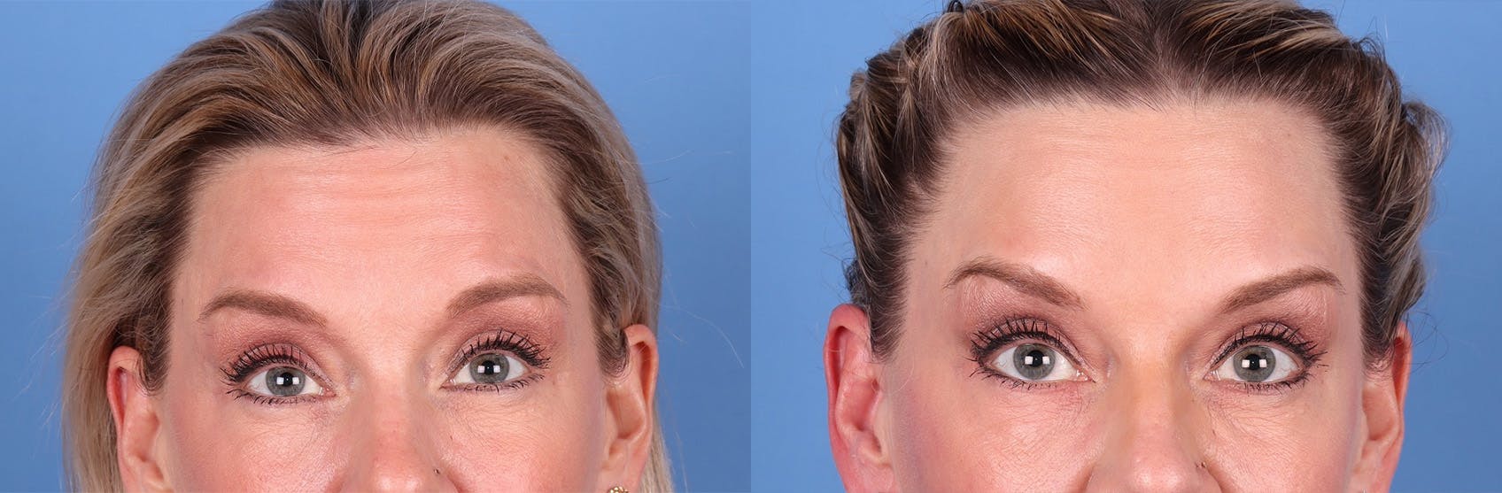 DAXXIFY Before & After Gallery - Patient 145105675 - Image 1