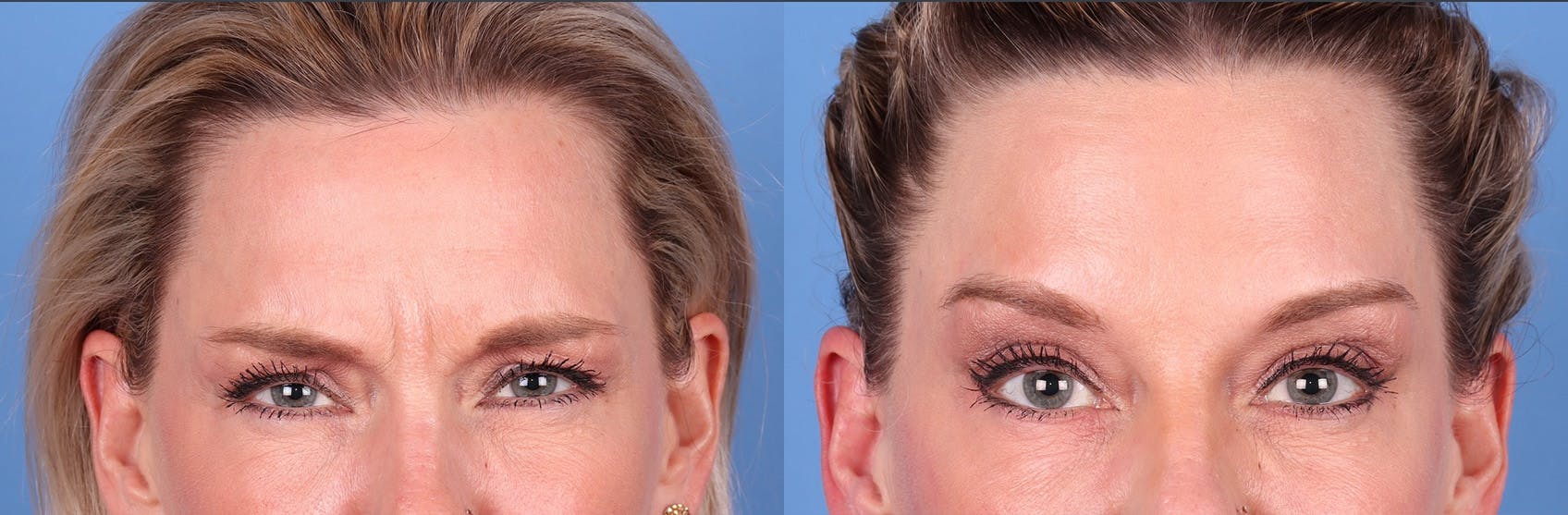 DAXXIFY Before & After Gallery - Patient 145105675 - Image 2