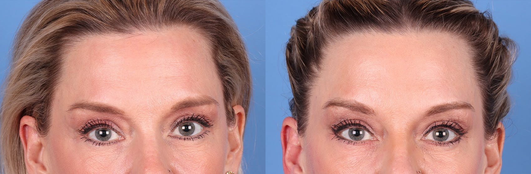 DAXXIFY Before & After Gallery - Patient 145105675 - Image 3