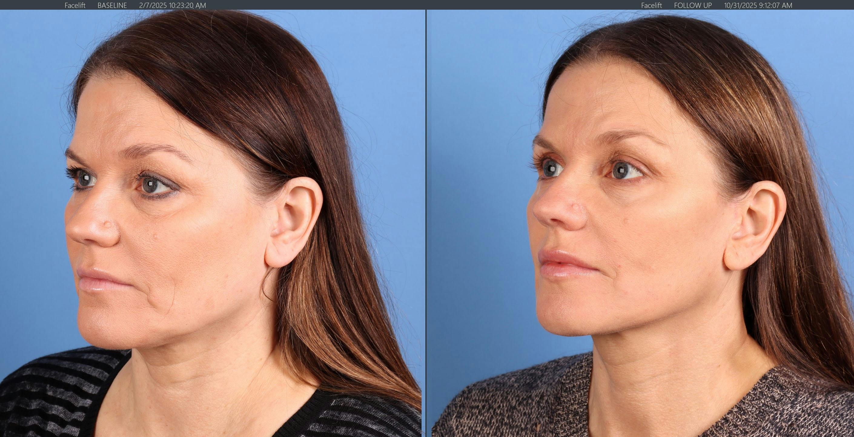 Face Lift Before & After Gallery - Patient 116749 - Image 2