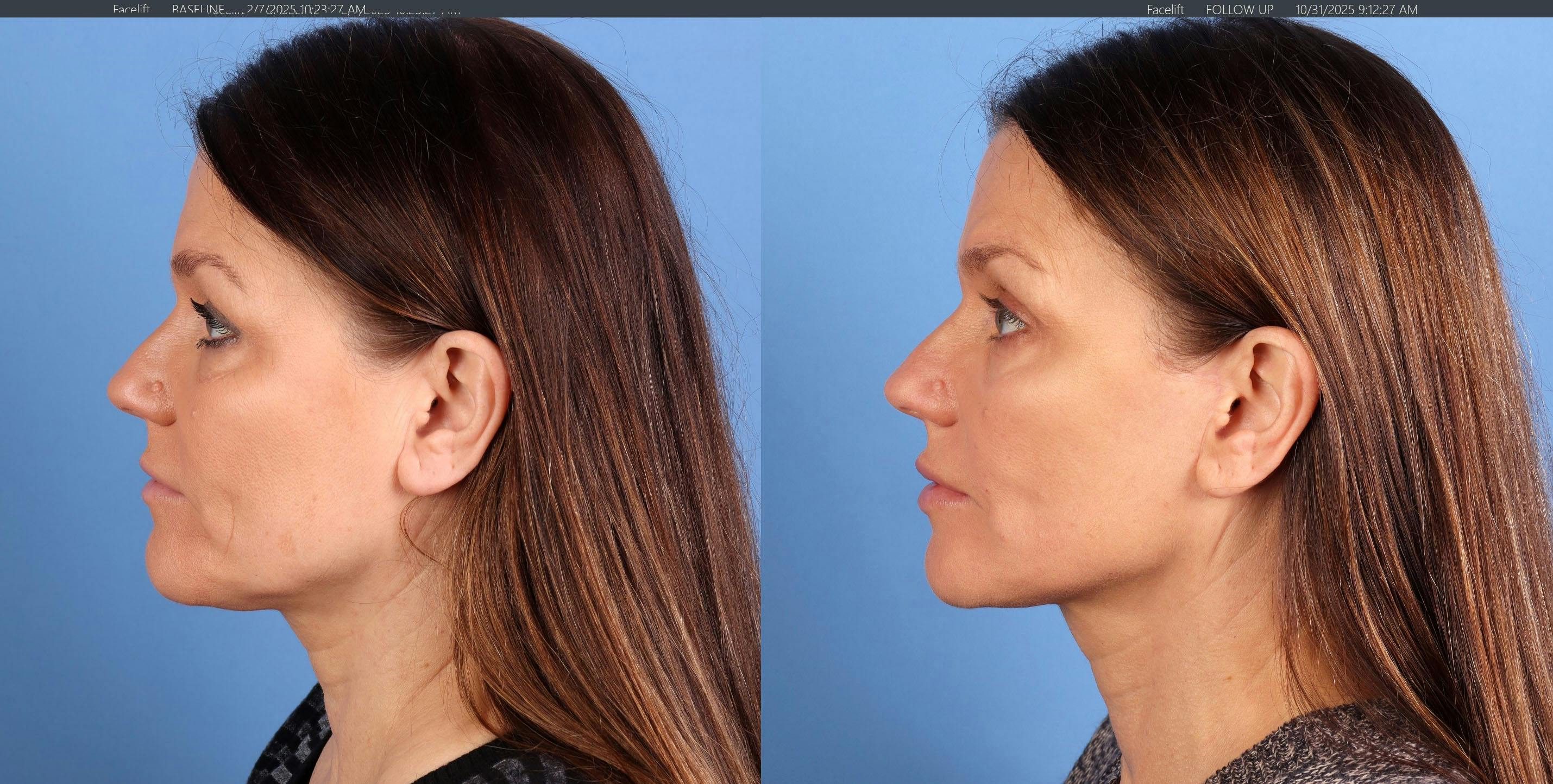 Face Lift Before & After Gallery - Patient 116749 - Image 3