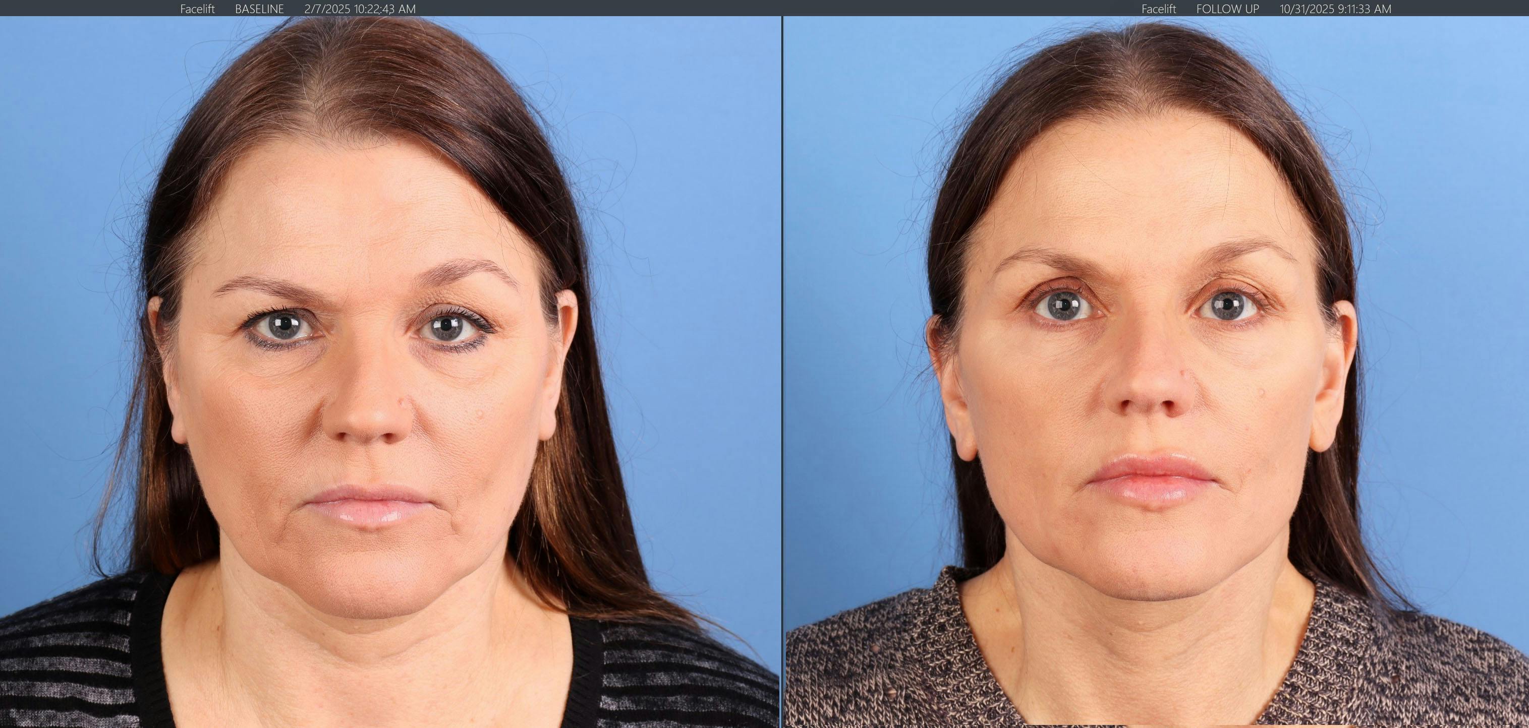 Face Lift Before & After Gallery - Patient 116749 - Image 1