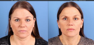Face Lift Before & After Gallery - Patient 116749 - Image 1