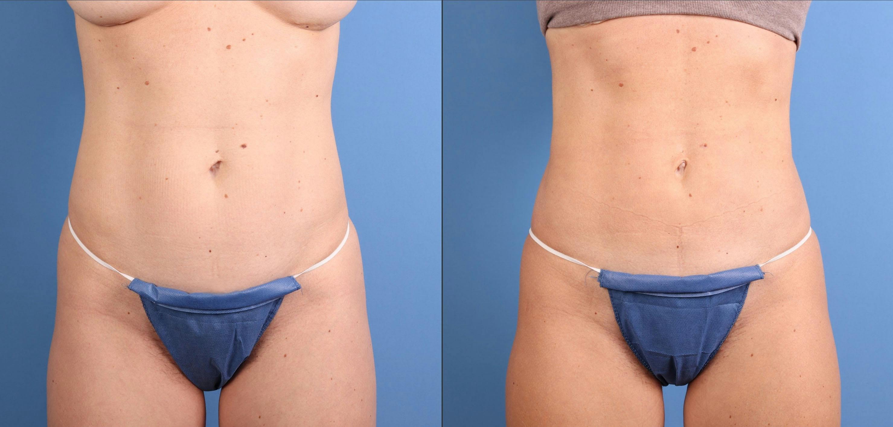 Abdomen Before & After Gallery - Patient 253173 - Image 1