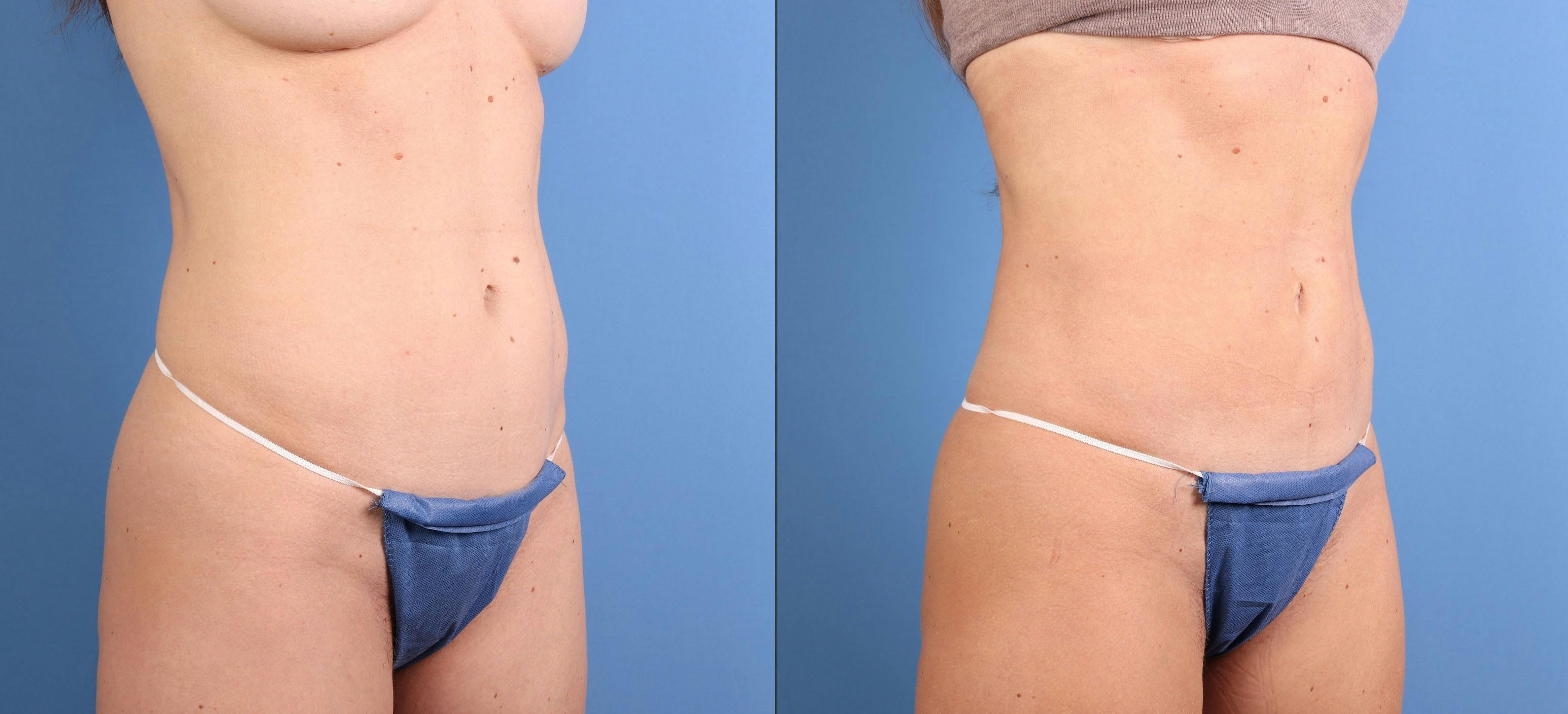 Abdomen Before & After Gallery - Patient 253173 - Image 2