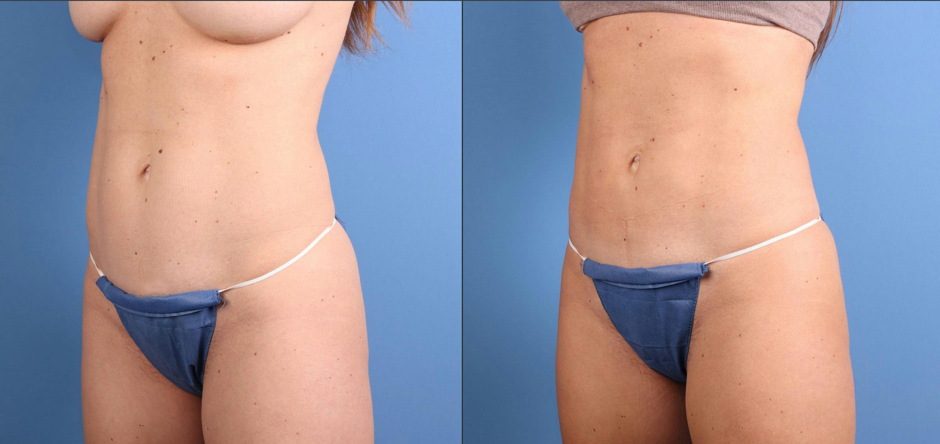 Abdomen Before & After Gallery - Patient 253173 - Image 3