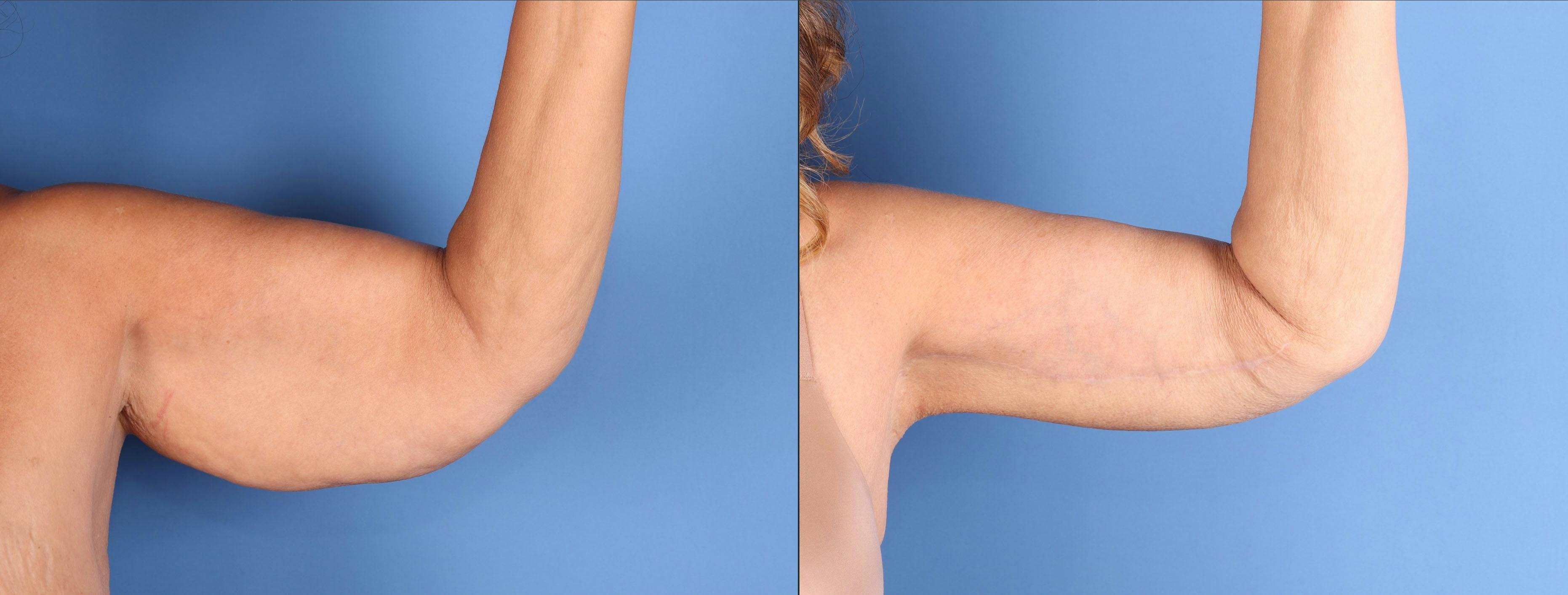 Arm Lift Before & After Gallery - Patient 273994 - Image 4