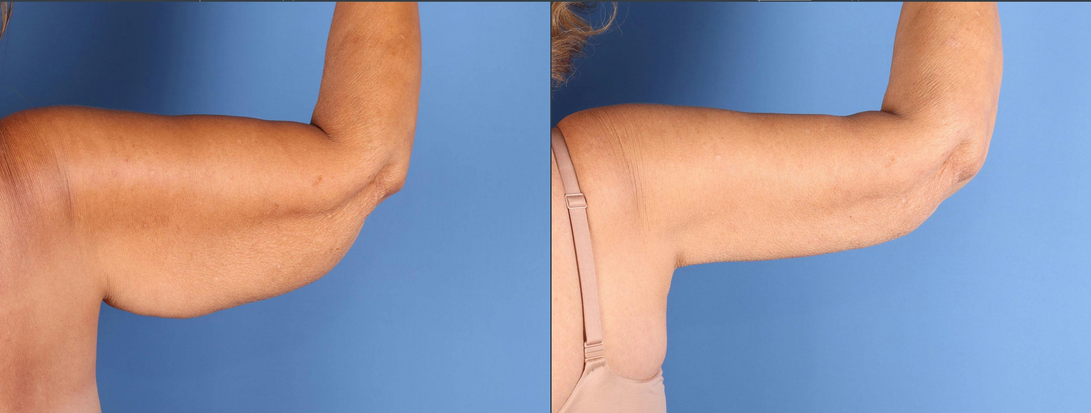Arm Lift Before & After Gallery - Patient 273994 - Image 3