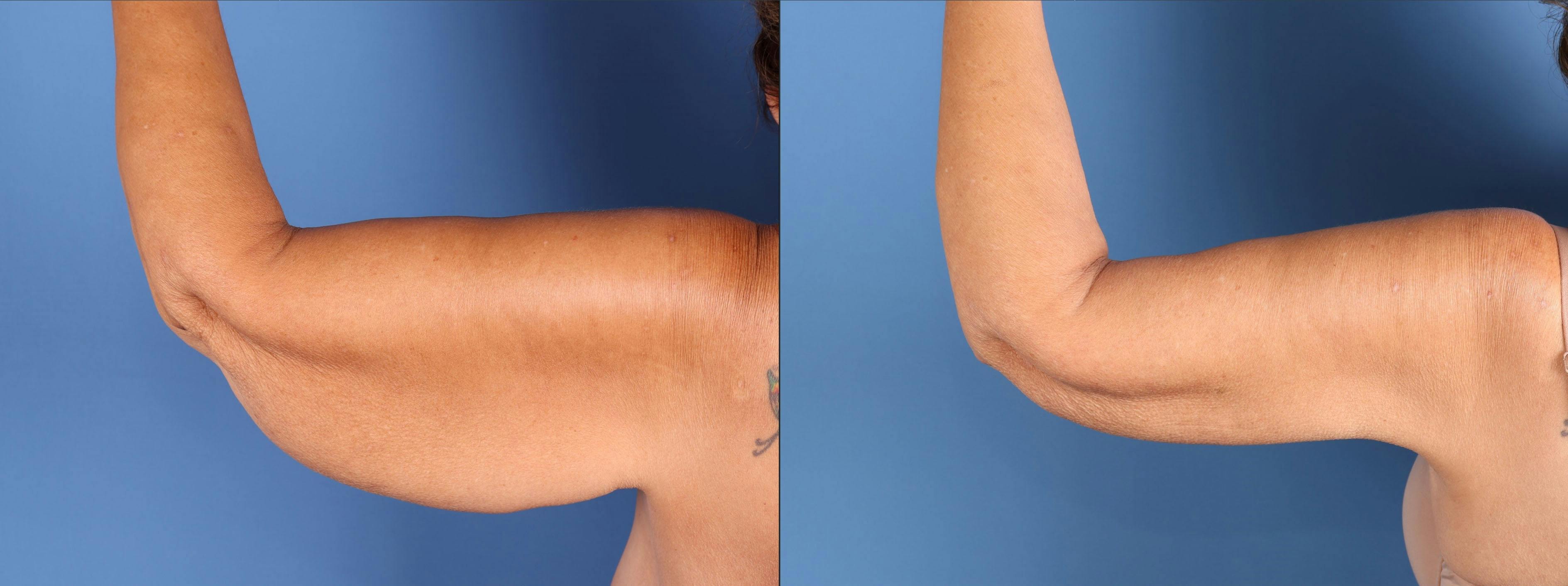 Arm Lift Before & After Gallery - Patient 273994 - Image 1