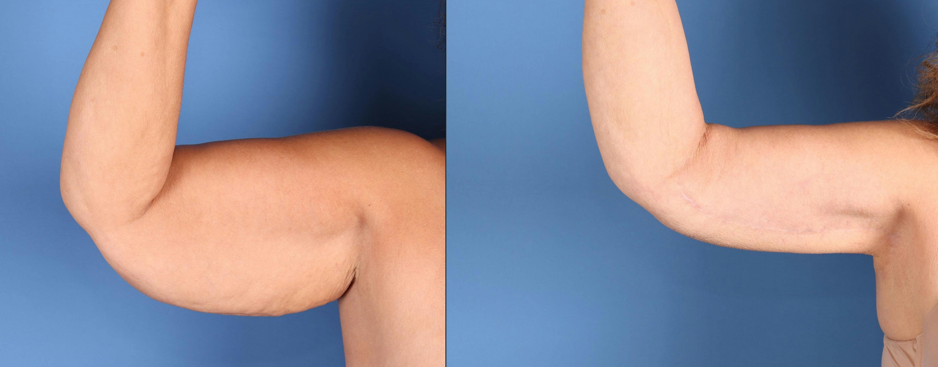 Arm Lift Before & After Gallery - Patient 273994 - Image 2