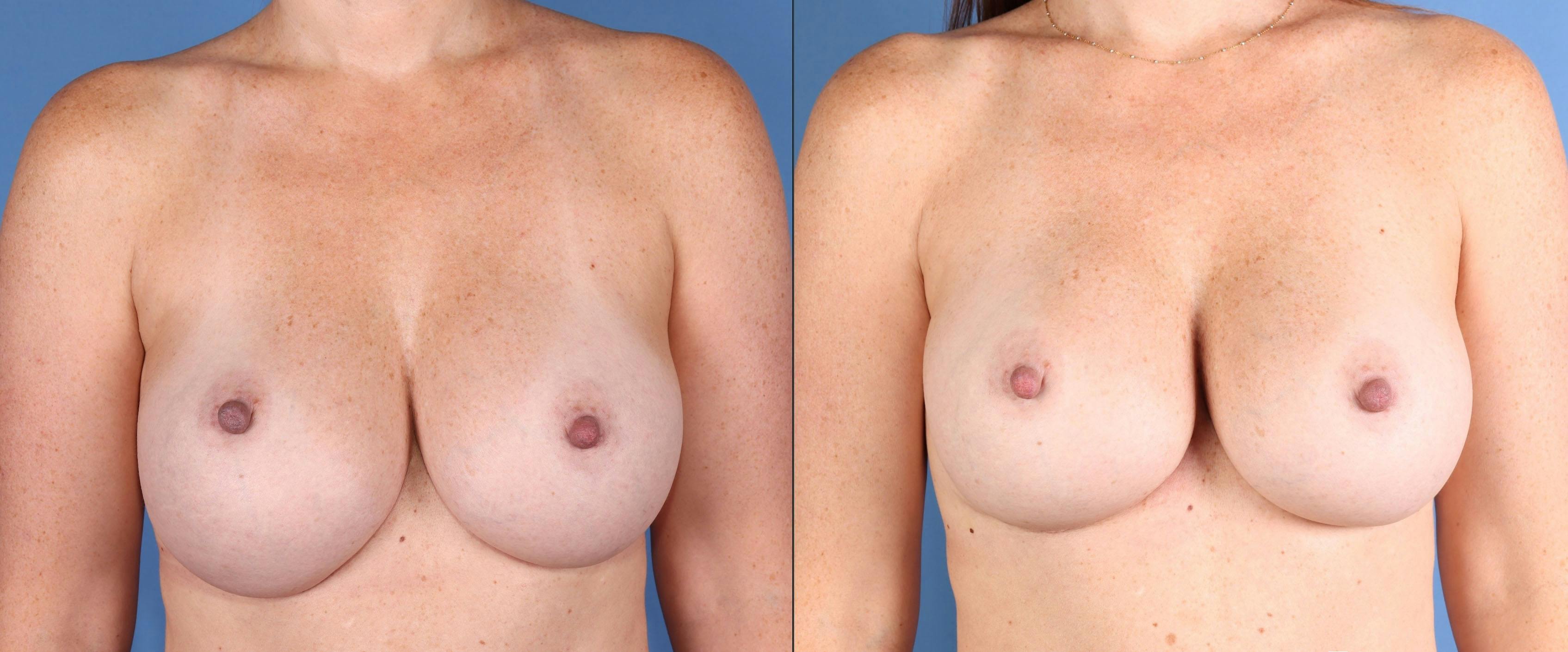 Breast Revision Before & After Gallery - Patient 124462 - Image 1