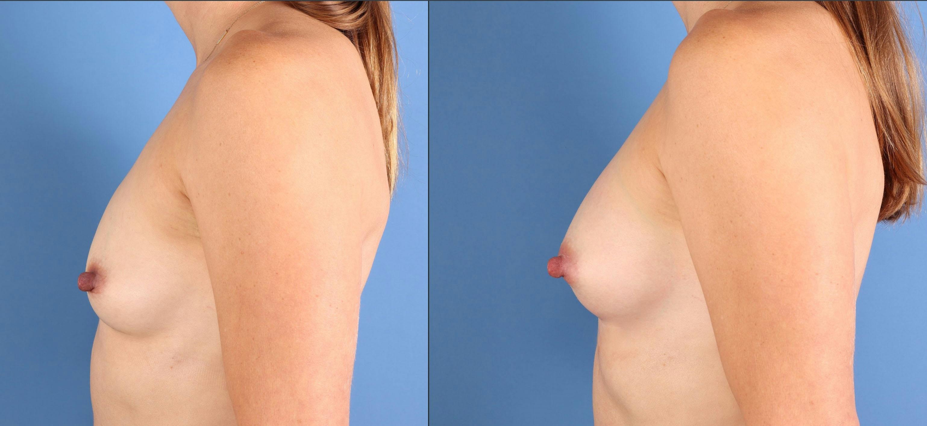 AlloClae Before & After Gallery - Patient 275863 - Image 5