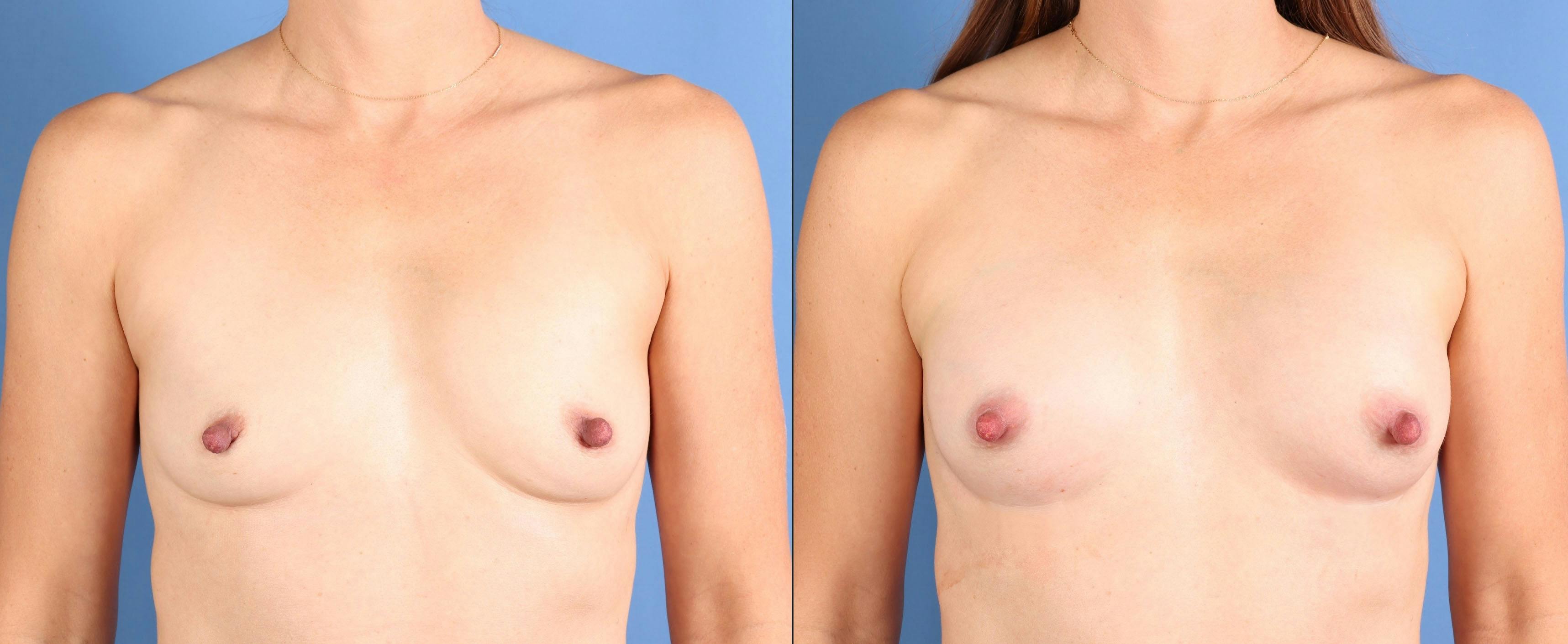 AlloClae Before & After Gallery - Patient 275863 - Image 1