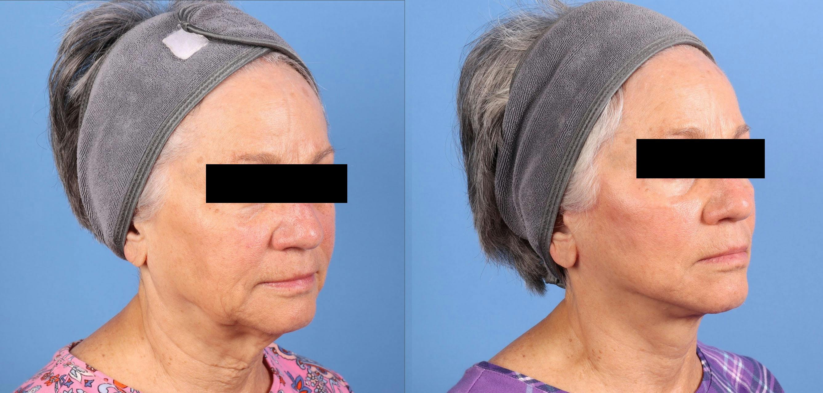 Face Lift Before & After Gallery - Patient 218170 - Image 4