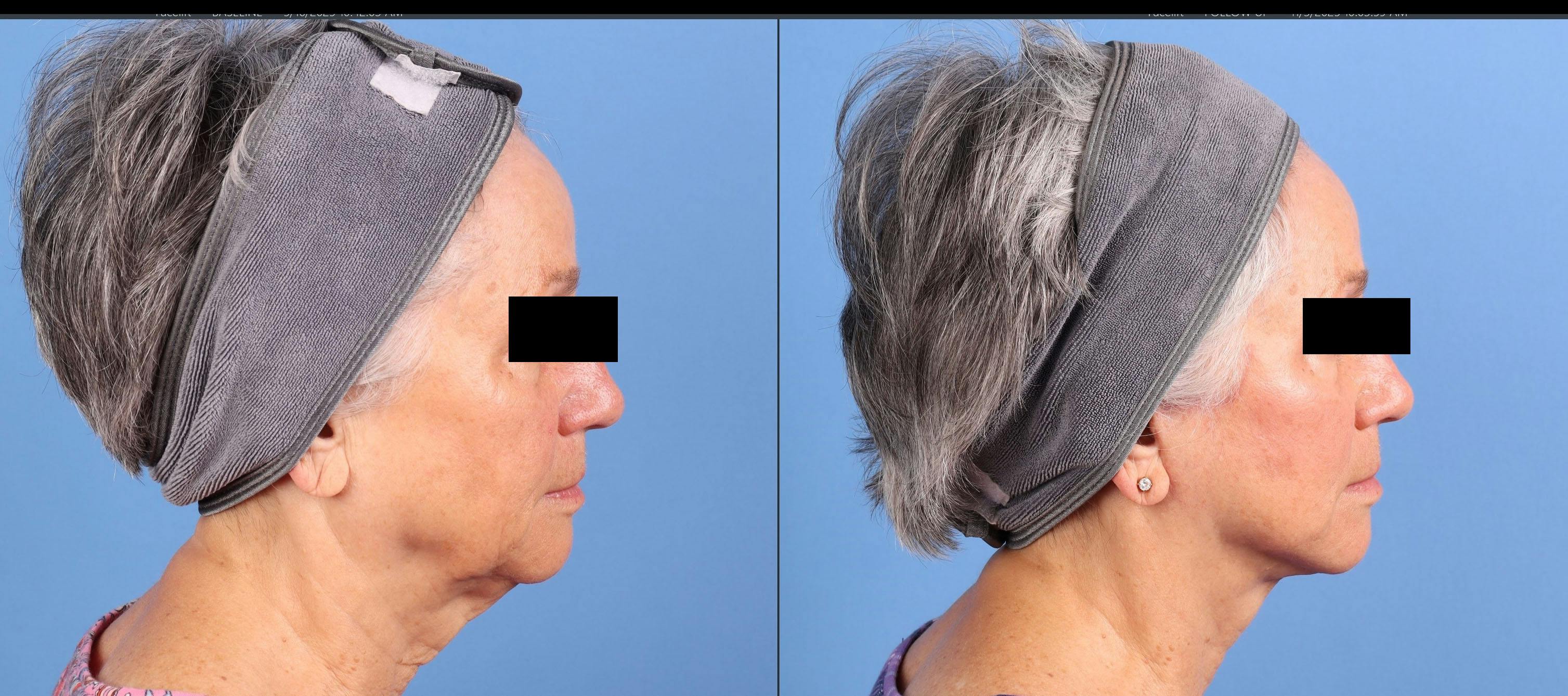 Face Lift Before & After Gallery - Patient 218170 - Image 5