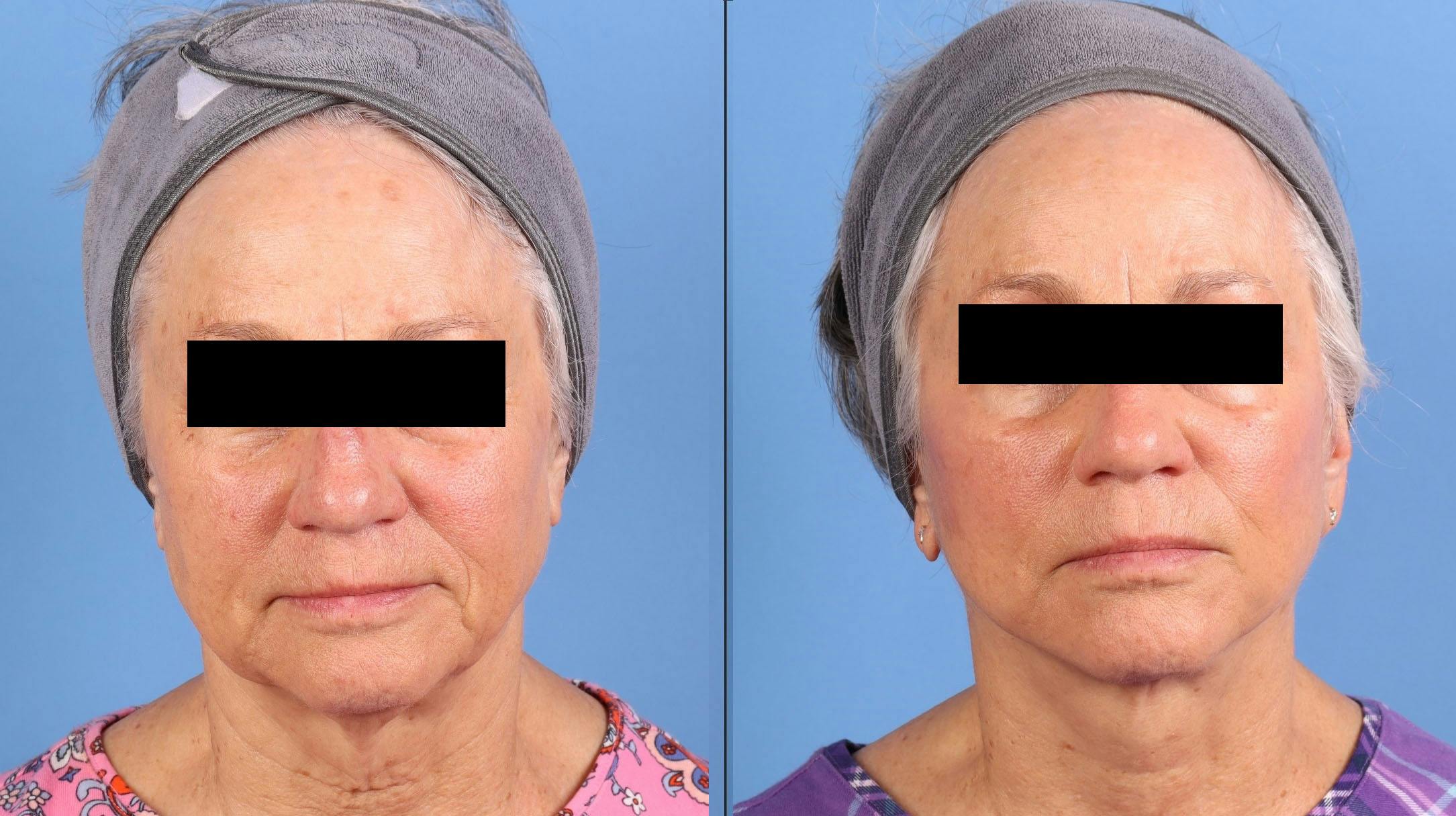 Face Lift Before & After Gallery - Patient 218170 - Image 1