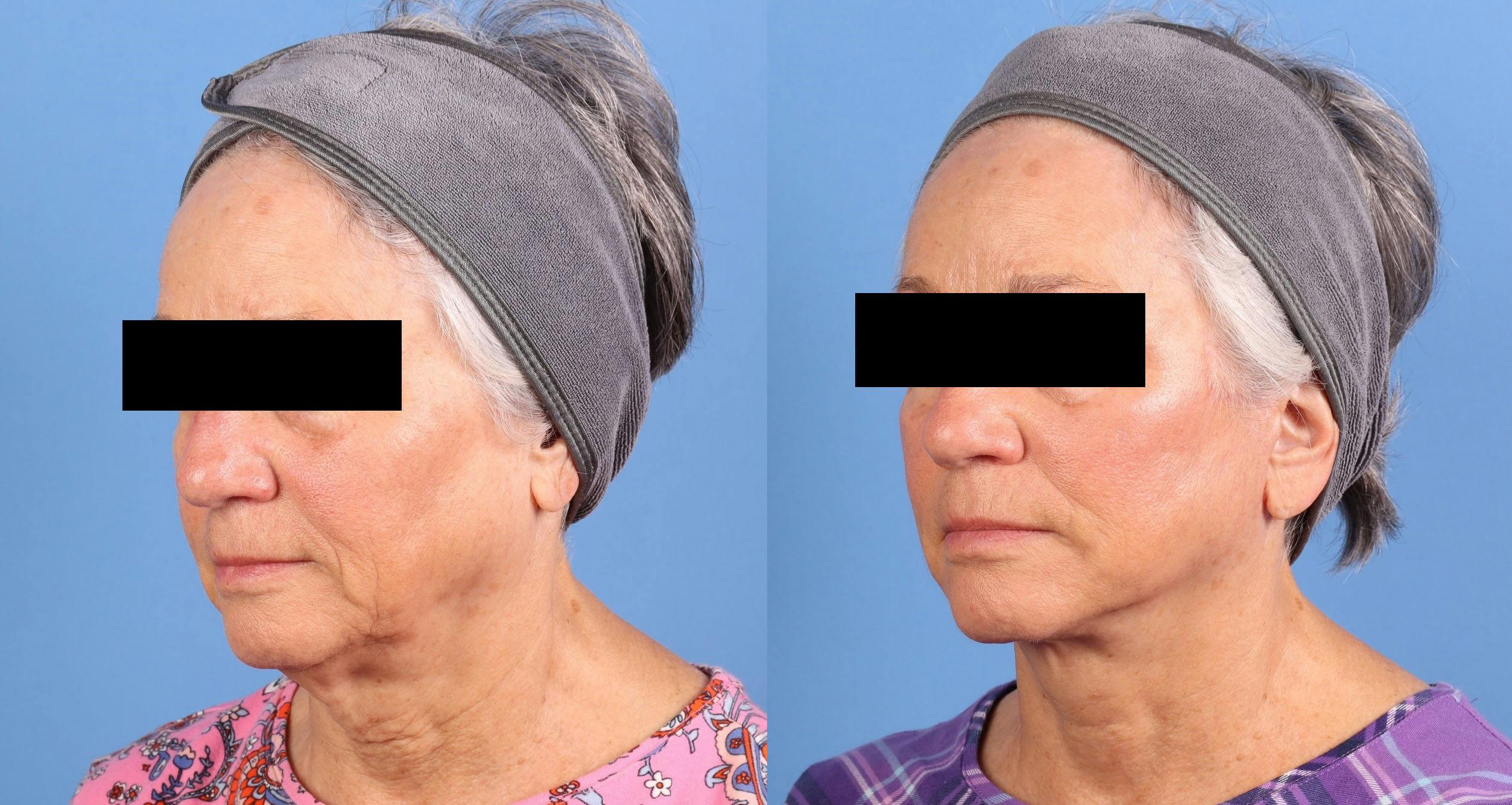 Face Lift Before & After Gallery - Patient 218170 - Image 2