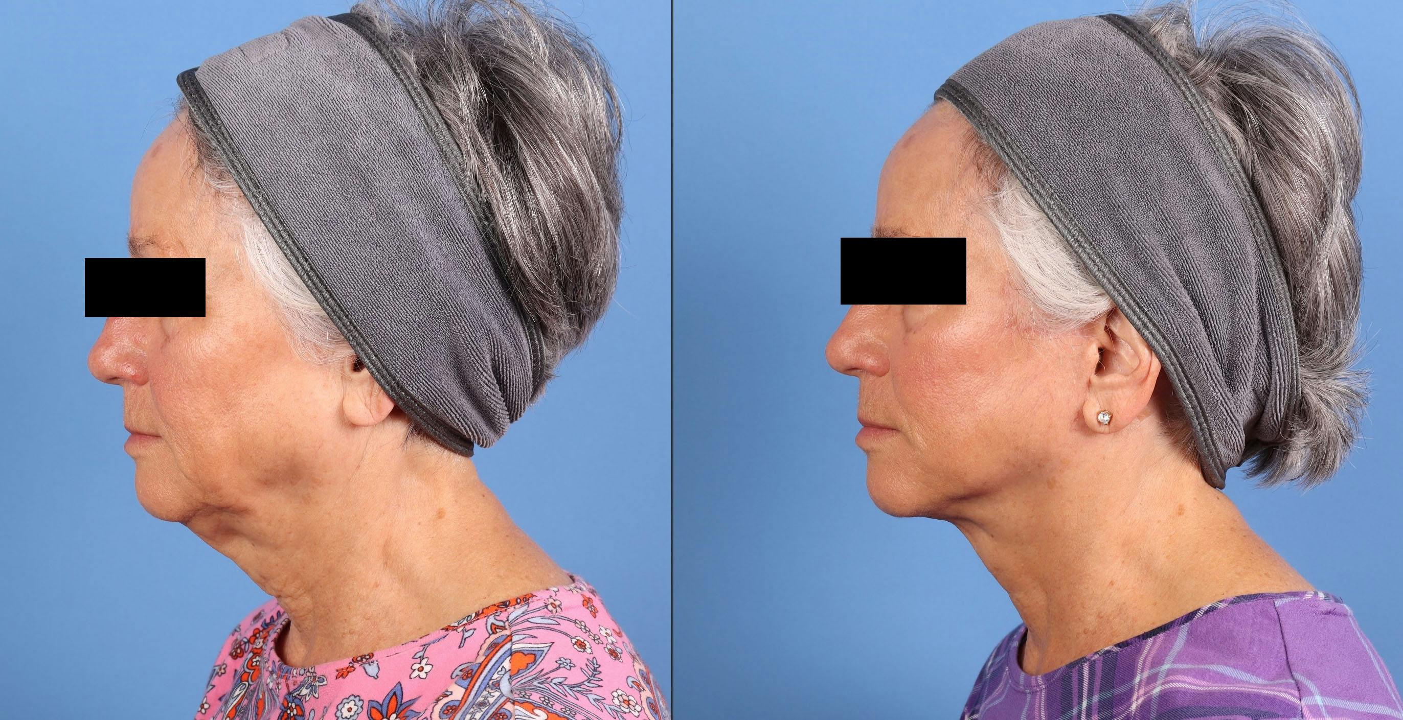 Face Lift Before & After Gallery - Patient 218170 - Image 3
