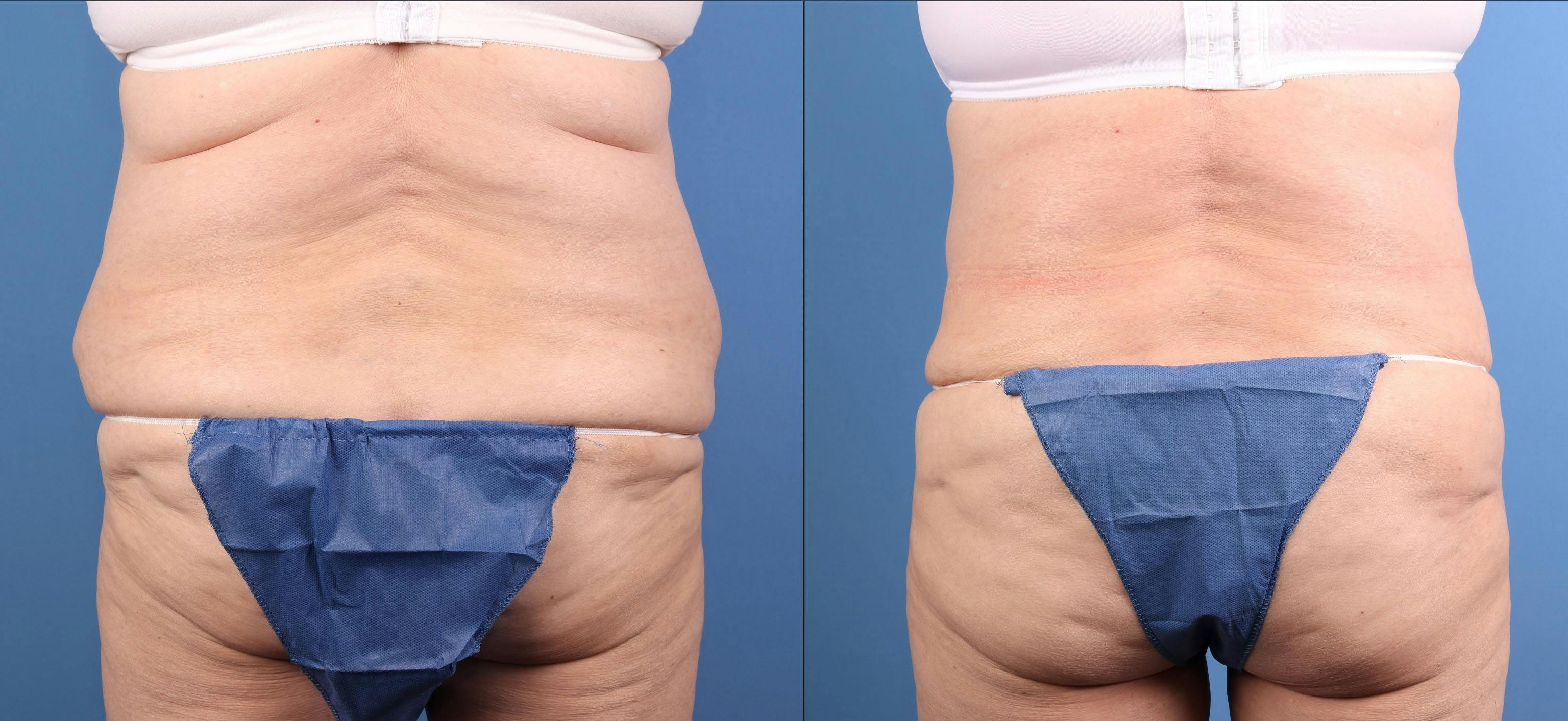 Tummy Tuck Before & After Gallery - Patient 632059 - Image 4