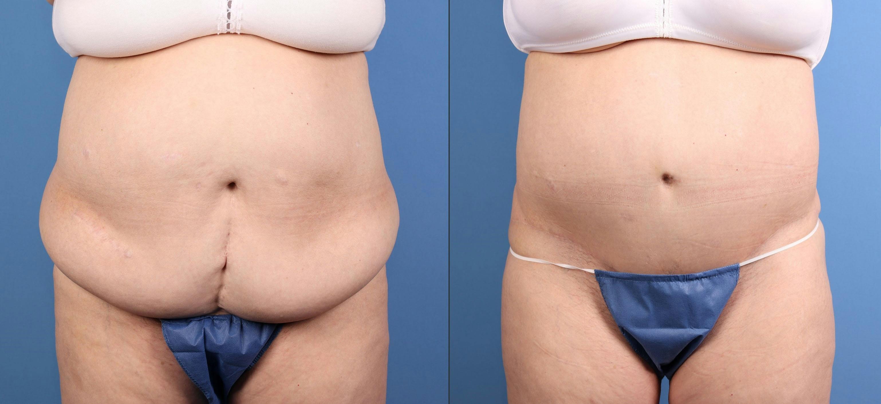Tummy Tuck Before & After Gallery - Patient 632059 - Image 1