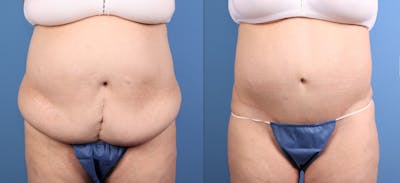 Tummy Tuck Before & After Gallery - Patient 632059 - Image 1