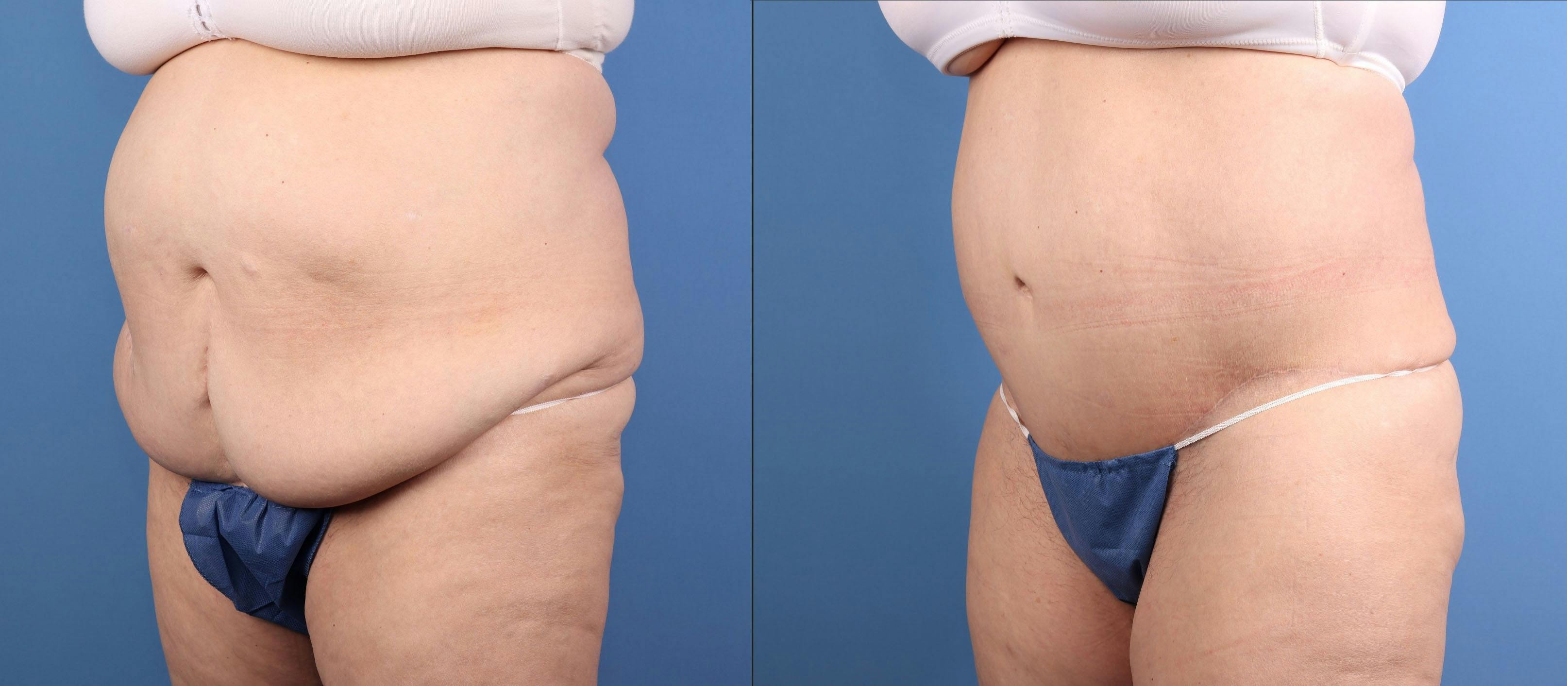 Tummy Tuck Before & After Gallery - Patient 632059 - Image 3
